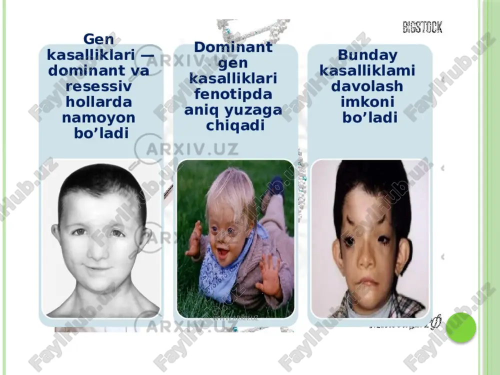 klin antibiotiklaridan foydalanish yangi tug'ilgan chaqaloqlarda kataraktaga olib kelishi mumkin. ob'ektiv shaffofligini ta'minlash uchun tug'ma katarakt rivojlanishiga sabab bo'ladigan oqsillar tarkibidagi genetik o'zgarishlar. tug'ma kataraktalar ko'zning barcha rivojlanish anomaliyalarining 60% ni tashkil qiladi va yangi tug'ilgan chaqaloqlarning taxminan 0,4% da uchraydi. tug'ma kataraktlarning aksariyati jarrohlik uchun ko'rsatma, lekin ba'zi hollarda, linzalarning shaffofligi periferik bo'lsa va markaziy ko'rishni kamaytirmasa, jarrohlik davolash talab qilinmaydi. marfan sindromi (yoki araxnodaktiliya) - biriktiruvchi to'qima yetishmasligi bilan tavsiflanadigan irsiy kasallik marfan sindromi fibrilin oqsil genining 15 -xromosomasining mutatsiyasidan kelib chiqadi, buning natijasida kollagen tuzilishi va ishlab chiqarilishi buziladi. kasallik yurak -qon tomir, asab, mushak -skelet va boshqa tizim va organlarda patologik o'zgarishlarga olib keladi araxnodaktiliya autosomal -dominant tarzda meros qilib olingan, shuning uchun u erkak va ayollarda deyarli bir xil nisbatda uchraydi. bu 1: 5000 tez -tez uchraydigan juda kam uchraydigan genetik kasallik. tabut-lovi sindromi-skeletning o'zgarishi, o'sishning kechikishi, eshitishning buzilishi bilan kechadigan x-ga bog'liq aqliy zaiflikning …