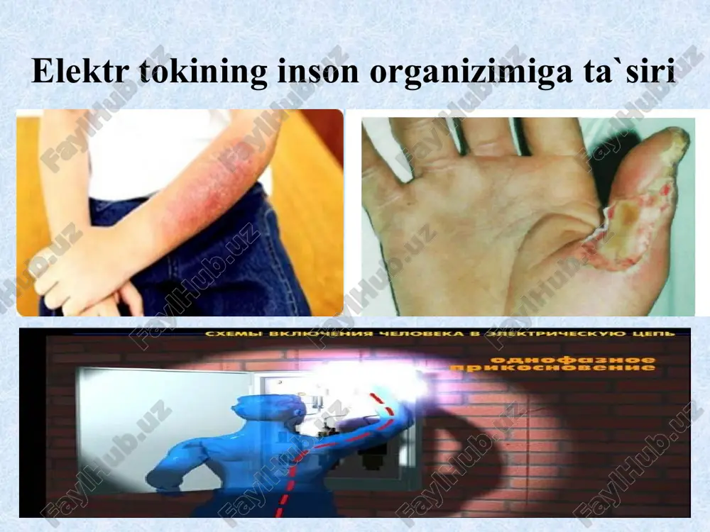 yordam ko`rsatish agar jarohatlangan kishining nafas olishi qiyinlashsa, qaltirash holati bulsa, ammo yurak urish ritmi nisbatan yaxshi bulsa, unda bu kishiga sun`iy nafas oldirish zarur. klinik o`lim holati yuz bergan taqdirda sun`iy nafas oldirish bilan bir qatorda yurakni ustki tomondan massaj qilish kerak. sun`iy nafas oldirish ”og’izdan og’izga” deb atalib, yordam ko`rsatuvchi o`pkasini havoga to`ldirib, jarohatlagan kishi og’zi orqali uning o`pkasiga bu havoni haydaydi. bunda yordam ko`rsatayotgan kishi og’zi bilan, jarohatlangan kishining og’zini butunlay berkitishi va yuzi yoki panjalari yordamida uning burnini berkitish kerak. bir minutda taxminan 10-12 marta puflashni, doka dastro`mol va trubka orqali ham bajarish mumkin, sun`iy nafas oldirishni bemor o`ziga kelguncha davom ettiriladi. yurakni tashqaridan massaj qilish jarohatlangan kishi organizmidagi qon aylanishni sun`iy ravishda tiklab turish maqsadida amalga oshiriladi. tok ta`siriga tushgan kishiga birinchi yordam ko`rsatish qorin bushlig’idan ko`krak qafasiga o`tgandan keyin 2 barmoq yuqoridan massaj qilinadigan joyni belgilab, qo`lni bir-biri ustiga to`g’ri burchak shaklida qo`yib, jarohatlangan …