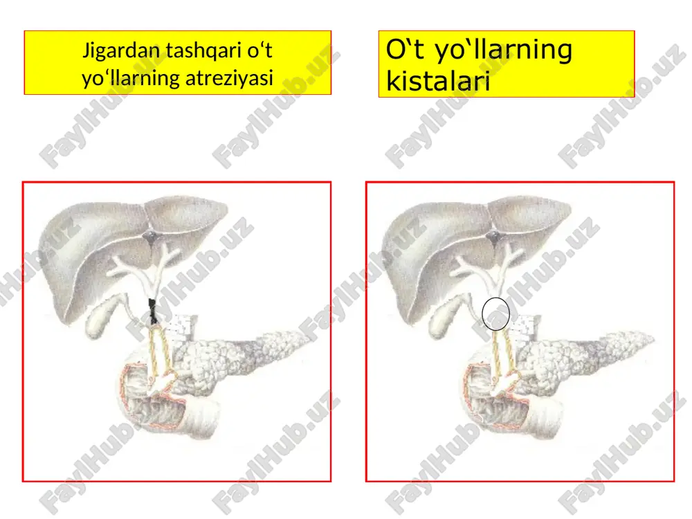 ini tozalash (oshqozon yuvish, sifonli ho‘kna) kortikosteroidlar katta dozada tavsiya qilish (prednizolon, gidrokortizon) proteolitik fermentlarni tavsiya etish (trasilol, kontrikal, gordoks) o‘t passajini tiklaydigan jarrohlik amaliyotlar endoskopik papilosfinkterotomiya dormiya zondi orqali o‘t toshlarini olib tashlash yumshoq qisqich orqali o‘t toshlarini olib tashlash fogarti zondi yordamida orqali o‘t toshlarini olib tashlash xoledox terminal qismini ikkilamchi strikturasida dilatatsiya qilish ikkitali lateksli balon yordamida toshlarni olib tashlash mexanik litotripsiya va aspiratsion usul toshni olish uchun “halqali-ilmoq”ni qo‘llash endoskopik retrograd papillosfinkterotomiya epstdan oldin epstdan keyin endoskopik retrograd pankreatoxolangiografiya dormi savatchasi yordamida o‘t toshlarini olib tashlash dormi savatchasi yordamida o‘t toshlarini olib tashlash umumiy xoledox terminal qismini strikturasini dilatatsiyasi lateksli balon yordamida toshlarni olish mexanik litotripsiya va aspiratsion usul tosh olish uchun “halqali-ilmoq” tjxsga ko‘rsatmalar erpxg qilish imkoniyati yoki uning natijasi bo‘lmaganda, yoki unga karshi ko‘rsatma bo‘lganda o‘t yo‘lini to‘suvchi gepatikopankreatoduodenal sohaning o‘smalari. tjxsga qarshi ko‘rsatma punksiya qilish sohasidagi o‘sma pti ning 50% gacha pasayib ketishi …