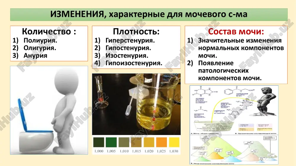i gematurii makrogematuriya - virajennaya (mocha tsveta «myasnix pomoev») – bolee 50 eritrotsitov v pole zreniya umerennaya - 30-50 eritrotsitov v pole zreniya neznachitelnaya – do 30 eritrotsitov v pole zreniya prodoljitelnost gematurii kratkovremennaya (naprimer, pri proxojdenii kamnya) intermittiruyushaya (bolezn berje) stoykaya, upornaya (razlichnie varianti glomerulonefrita, nasledstvenniy nefrit, nekotorie vidi displazii pochki) leykotsituriya pri mochevom sindrome leykotsituriya - povishenie leykotsitov v moche (v moche zdorovogo cheloveka soderjatsya v kolichestve 0 - 3 v p/zr. u mujchin i 0-6 v p/zr. u jenshin). 1. uvelichenie soderjaniya leykotsitov nablyudaetsya pri vospalitelnix protsessax v pochkax i mochevivodyashix putyax. 2. tranzitornaya (prexodyashaya) leykotsituriya vstrechaetsya pri lixoradke, v t.ch vnepochechnogo proisxojdeniya. initsialnaya i terminalnaya leykotsituriya imeet vnepochechnoe proisxojdenie. 3. o pochechnom proisxojdenii leykotsiturii svidetelstvuet totalnaya leykotsituriya s odnovremennim prisutstviem v mochevom osadke leykotsitarnix i zernistix tsilindrov. 4. dlya razgranicheniya mikrobnoy i asepticheskoy leykotsiturii imeet znachenie viyavlenie piurii i bakteriologicheskoe issledovanie mochi. o piurii govoryat, kogda …
