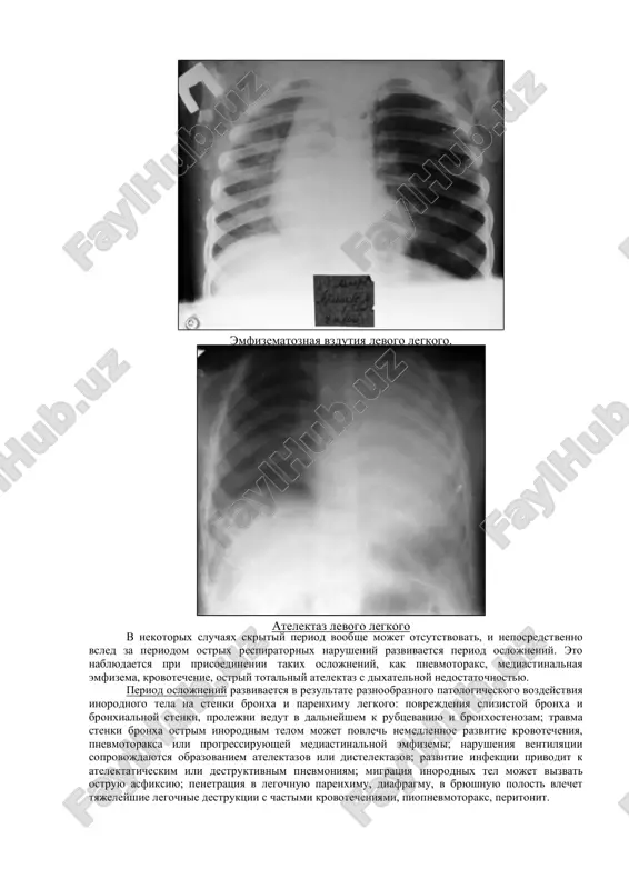 x narusheniy, skritogo techeniya i oslojneniy. period ostrix respiratornix narusheniy po vremeni sootvetstvuyut momentu aspiratsii i proxojdeniya inorodnogo tela cherez verxnie dixatelnie puti. dlitelnost etogo perioda mojet virirovat ot neskolkix minut do neskolkix chasov, kogda inorodnoe telo zaderjivaetsya na urovne gortani ili traxei i lish pozje smeshaetsya v bronx. simptomi etogo perioda sleduyushie: ostriy pristup kashlya, muchitelniy kashel, soprovojdayushiysya rvotoy, yavleniya udushya i tsianoza. pri ob'ektivnom osmotre rebyonka v etom periode obrashayut na sebya vnimaniyu inspiratornaya odishka, povtornie pristupi kashlya, virajennoe bespokoystvo rebenka. period skritogo techeniya nastupaet posle peremesheniya inorodnogo tela v bronx, prichem, chem dalshe ot glavnix bronxov raspolagaetsya inorodnoe telo, tem menee virajeni klinicheskie simptomi v eto vremya. etot period xarakterizuetsya ischeznoveniem vneshnix proyavleniy aspiratsii inorodnogo tela- dixaniya rebyonka stabiliziruetsya, povedenie stanovitsya obichnim, a redkie pristupi kashlya rastsenivayutsya roditelyami kak rezultat lyogkoy prostudi. dlitelnost skritogo perioda variruet ot neskolkix chasov do 7-10 dney. edinstvennimi vneshnimi priznakami neblagopoluchiya mogut …
