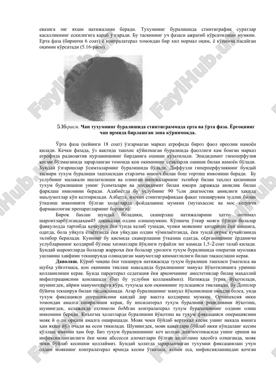 o'simtalarning buralishi moyak terisining aniq ifodalangan qalinlashishi va qizarishi bilan namoyon bo'lishi mumkin. diagnostikada og'riq lokallashuvining aniq ifodalanishi yordam berishi mumkin. shunday qilib, e'tibor bilan lekin muloyim palpatsiyada ba'zan lokal og'riqlilik aynan o'simta (epididimit), tuxum (tuxum buralishi) yoki osilish (osilish buralishi) sohasida aniqlanadi. moyak ichidagi hosilalarning o'zaro munosabatlarining anatomik o'zgarishi diagnostikada o'ziga xos rolni o'ynamaydi. biroq moyakda ko'ndalang yotgan tuxumning anomal holati, o'simtaning oldinda joylashuvi, arqonchaning qisqarishi natijasida tuxumning ko'tarilgan holati va zararlangan tomonda leremaster reflekstning yo'qligi - ushbu barcha omillar tashxisni aniqlashtirish imkonini beradi. shu bilan birga aytib olilgan simptomlaming birortasi ham patognomonik hisoblanmaydi, shuning uchun ulaming hammasi shartlilikning ma'lum hissasi bilan ko'rib chiqilishi kerak. katta diagnostik ahamiyat lokalizatsiyasi bo'yicha buralgan osma, tuxum yoki o'simtaga mos kelishi «ko'k nuqta» simptomiga (agar u bo'lsa) beriladi. ba'zan bu simptom moyakning shishi va giperemiyasi tufayli, ayniqsa kasallikning 24 soatdan oshadigan eskiligida aniqlanmaydi. bunday holatda qarong ' ulashtiri1gan xonada trnasilliyuminatsiya (o'tayotgan yorug'likda tekshiruv) …
