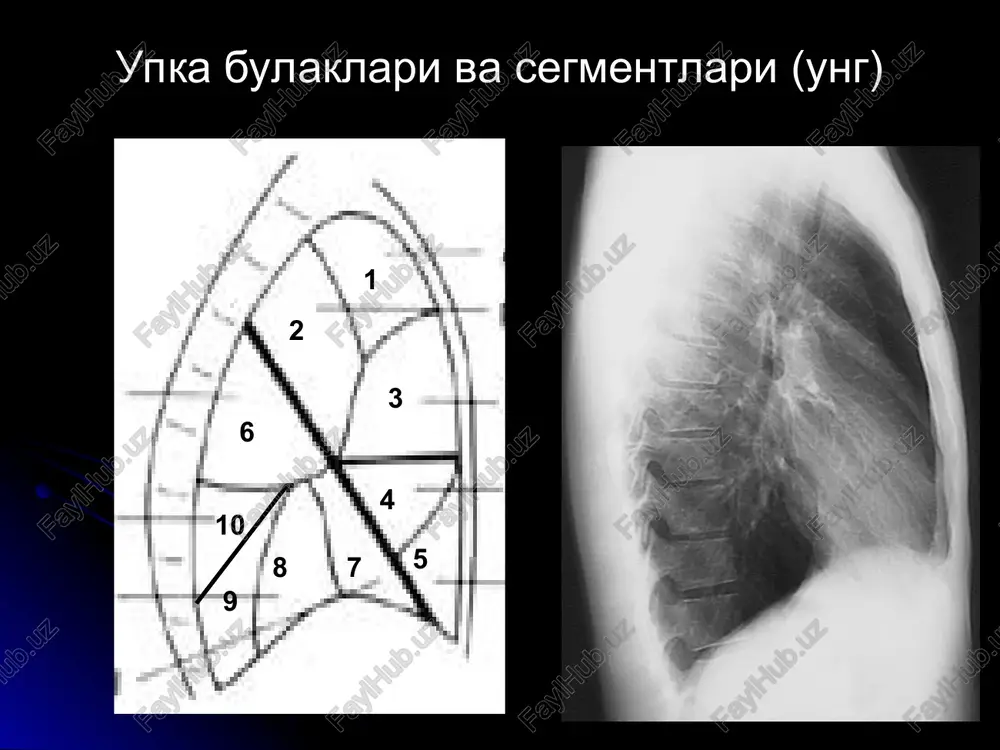 ), pnevmoniya surunkali klinika - pnevmokonioz (changli anamnez) va sgds (fibroz+ emfizema+ limfatugunlar kattalashishi va oxaklanishi) + yurak kasalliklari - gemosideroz, upka shishi alveolar va interstitsial jaraen farklari belgi alveolar interstitsial uchok ulchami > 5 mm <5 mm uchoklar birlashishi xa yuk chegaralari notekis tekis jaraen xajmi chegaralangan bulishi mumkin diffuz (ikkala upka) tashxislanish vakti erta kech interstitsial kasalliklar pnevmoniyalar (miliar sil, virus, zamburug) metastaz (kartsinomatoz) upka shishi (yurak kasalliklari) chang kasalliklari (pnevmokoniozlar) kollagenozlar (revmatizm, skv va boshkalar) boshkalar: sarkoidoz, proteinoz belgilari: uchoklar, tur-simon uzgarishlar miliar pnevmoniya miliar sil miliar metastaz pnevmoniya pnevmokonioz pnevmokonioz miliar kasalliklarni kt ertarok aniklaydi upka ildizi kasalliklari politsiklik ildiz - limfa tugunlar kattalashgan - mts, limfoproliferativ kasalliklar, bronxoadenit, pnevmokonioz, sil, zamburug va virus infektsiya oxaklashgan l.tugunlar - surunkali yalliglanish (pnevmokonioz, sil) tongi oftob - markaziy rak, + atelektaz kengaygan ildiz - mitral poroklar, tugma ok poroklar, upka arteriyasi anevrizmasi toraygan ildiz – “kuk” yurak poroklari …
