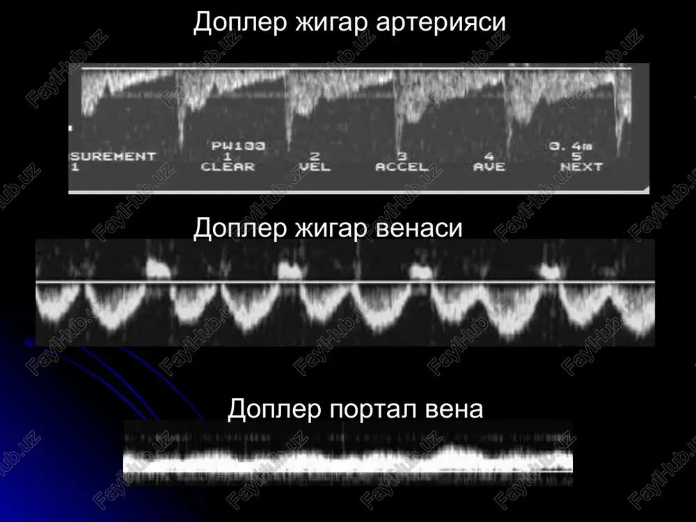 lmakchalar», a-v shunt tsirroz rakni aniklashga tuskinlik kiladi metastazlar eng kup uchraydigan usma yugon ichak (42%), oshkozon, oob, kukrak bezi va upkadan kup sonli, yumalok, chegarasi tekis, ulchami 1.5 sm gacha (90%), nogomogen bulishi mumkin (kon, kaltsinat, nekroz), atrofida shish zonasi us - giper-izo-gipoexogen kt - gipodensiv kt+kontrast - erta va yaxshi yigadi mts xoletsistit utkir toshli (80-90%), keksa aellar (x3) sg - devori > 3mm, 3 kavatli, ulchami katta, ut nogomogen, tosh - giperexogen, akustik soya va siljish toshlar 85% oxaklashmagan, turlari - xolesterin (70%), bilirubin (30%), toshsiz (10%) kupincha operatsiyadan sung, belgilari yukoridek, lekin tosh yuk. surunkali - chandikli deformatsiya +funktsiyasi buzilishi tosh ut yulida bulsa xolangiografiya axamiyatli poliplar akustik soya bermaydilar polip tosh utkir toshsiz xoletsistit utkir xoletsistitni sonografiya kursatmasa, radionuklid tekshiruv aniklashi mumkin (ut kopi kurinmaydi 4 soat ichida) region pediatric diagnostic center n.novgorod aloka, s85-639 teressi3 : oes iste) 4s x'steno! next egno) is ae …