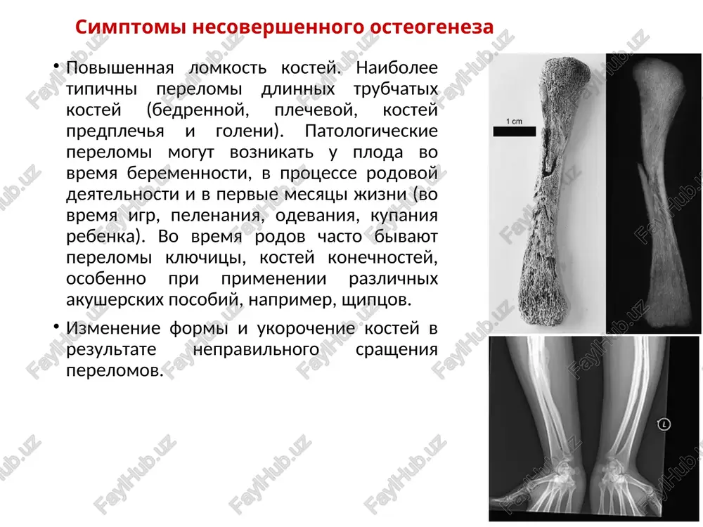 li slyuni s tselyu viyavleniya mutatsiy, xarakternix dlya zabolevaniya). vozmojna takje konsultatsiya terapevta, travmatologa-ortopeda. lechenie nesovershennogo osteogeneza tak kak dannoe zabolevanie yavlyaetsya nasledstvennim, to primenyayut tolko simptomaticheskie metodi lecheniya. v pervuyu ochered medikamentoznaya terapiya doljna bit napravlena na usilenie obrazovaniya glavnogo belka kostnoy tkani – kollagena. stimulyatorom yavlyaetsya somatotropin, parallelno s nim naznachayut antioksidanti, soli kaltsiya i fosfora, vitamin d2. posle okonchaniya kursa lecheniya somatotropinom naznachayut stimulyatori mineralizatsii kostnoy tkani (gormoni parashitovidnix jelez) i polivitaminnie preparati. takje ispolzuyut fizioterapevticheskie metodi lecheniya (elektroforez s solyami kaltsiya – proniknovenie lekarstvennogo veshestva v organizm cheloveka pod deystviem elektricheskogo polya), massaj, lechebno-profilakticheskuyu fizkulturu. v tyajelix sluchayax dlya ustraneniya deformatsiy (izmenenie formi i razmera) konechnostey pokazano operativnoe vmeshatelstvo. pokazaniem k xirurgicheskoy korrektsii yavlyayutsya ugloobraznie iskrivleniya segmentov konechnostey so znachitelnim umensheniem ix razmera. v dannom sluchae pribegayut k osteotomii (rassechenie kosti s tselyu ustraneniya nepravilnoy formi) s razlichnimi variantami osteosinteza (sopostanovlenie kostnix otlomkov pri pomoshi razlichnix …