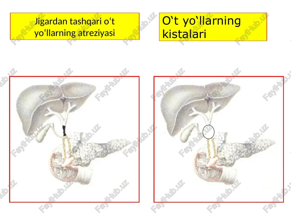 ini tozalash (oshqozon yuvish, sifonli ho‘kna) kortikosteroidlar katta dozada tavsiya qilish (prednizolon, gidrokortizon) proteolitik fermentlarni tavsiya etish (trasilol, kontrikal, gordoks) o‘t passajini tiklaydigan jarrohlik amaliyotlar endoskopik papilosfinkterotomiya dormiya zondi orqali o‘t toshlarini olib tashlash yumshoq qisqich orqali o‘t toshlarini olib tashlash fogarti zondi yordamida orqali o‘t toshlarini olib tashlash xoledox terminal qismini ikkilamchi strikturasida dilatatsiya qilish ikkitali lateksli balon yordamida toshlarni olib tashlash mexanik litotripsiya va aspiratsion usul toshni olish uchun “halqali-ilmoq”ni qo‘llash endoskopik retrograd papillosfinkterotomiya epstdan oldin epstdan keyin endoskopik retrograd pankreatoxolangiografiya dormi savatchasi yordamida o‘t toshlarini olib tashlash dormi savatchasi yordamida o‘t toshlarini olib tashlash umumiy xoledox terminal qismini strikturasini dilatatsiyasi lateksli balon yordamida toshlarni olish mexanik litotripsiya va aspiratsion usul tosh olish uchun “halqali-ilmoq” tjxsga ko‘rsatmalar erpxg qilish imkoniyati yoki uning natijasi bo‘lmaganda, yoki unga karshi ko‘rsatma bo‘lganda o‘t yo‘lini to‘suvchi gepatikopankreatoduodenal sohaning o‘smalari. tjxsga qarshi ko‘rsatma punksiya qilish sohasidagi o‘sma pti ning 50% gacha pasayib ketishi …