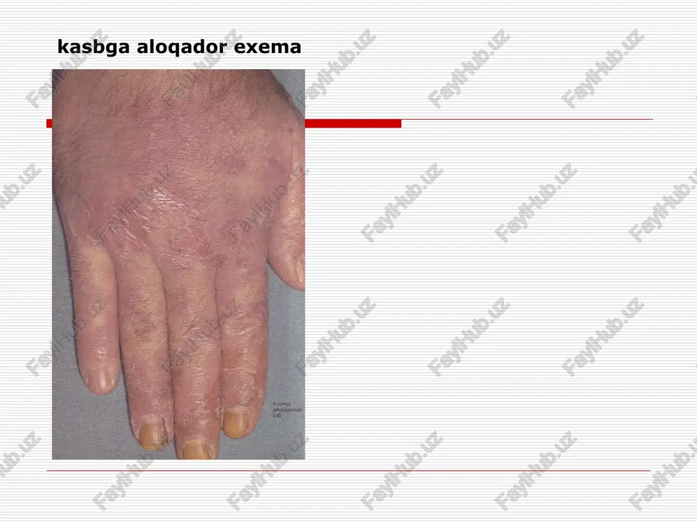 itlarini yachshilash atopik dermatit nasldan utadigan alllergik dermatoz surunkali kechuvchi ,qaytalanuvchi dermatoz . qichishish ,eritema ,tugunchalar paydo buladi , liheniszaciya eshak emi utkir va surunkali kechuvchi birlamchi toshma – urtika differencial diagnoz –dermatit duringa bilan eshak emi neyrodermit surunkali kechuvchi terining yalliglanishi . bu kasallikda eritematoz –lichenoidli toshmalar paydo buladi , bir biri bilan qushilgan. papulez infiltraciya uchoqlari paydo buladi va kup toshadigan joylarda lihenizaciya kuzatiladi neyrodermit turlari chegaralangan diffuz uchta zona markaziy (lihenizaciya ) urta (papulez ) periferik (giperpigmentaciya) qiyesiy tashhis (surunkali kechuvchi exema, qishima) qichima surunkali kechuvchi dermatoz –tugunchalar hosil buladi turlari : bolalar qichimasi (strofulus ) kattalar qichimasi tugunli qichima differencial tashhis –neyrodermit , kpl davolash komplexli asab, asab endokrin uzgarishlarni davolash infekciya uchoqlarini sanaciyasi gipoallergik diyeta sedativ vositalar giposensibilizacion terapiya immunokorregent vositalar neca? tddedal fe} rab hysupex @ ‘@. korea tamno paspemenue b tevehhh 9k3emato3hofo npotecca moxkho bliteiuts enenyromtue ctanhh: |. spuremarosnas craqua. ha koxe moabiafotca …