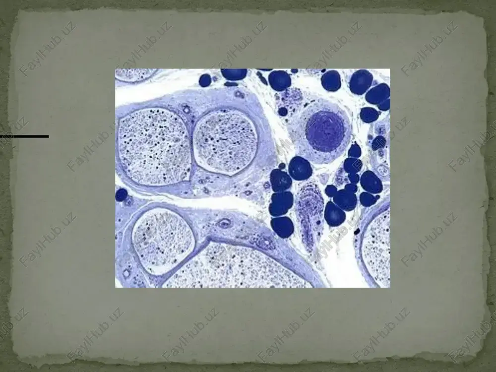 gripp, qizamiq, gemofil tayoqchalar, parotit, mikoplazma). – gerpetik infeksiyalar (smv, epstayn–barr, varicella-zoster). – oits va laym-borrelioz kasalligi. – turli virusli kasalliklarga (gripp, qoqshol, quturish) qarshi emlashlar. – xirurgik operatsiyalar. – turli dorilar (masalan, trombolitik dorilar) ning nojo‘ya ta’siri yoki asoratlari. – pns ga toksik ta’sir ko‘rsatuvchi kimyoviy vositalar, nur- lanishlar. – turli autoimmun kasalliklar (sistem qizil bo‘richa). – onkologik kasalliklar (limfogranulematoz, limfomalar). – etiologiyasi noaniq holatlar. tasnifi. giyen-barre sindromining 3 ta klinik turi farqlanadi. 1. o‘tkir yallig‘lanish bilan kechuvchi mielinsizlanuvchi poliradikulonevropatiya. bu gbs ning klassik turi bo‘lib, u 80– 90 % holatlarda uchraydi. 2. gbs ning aksonal turi (aksonal nevropatiya). kam uchraydigan turi, ya’ni 10–20 % ni tashkil qiladi. 3. miller-fisher sindromi. juda kam (1–3 %) uchraydi. difteriya polinevriti difteriyaning o‘tkir belgilaridan 2—3 haftadan keyin asab tizimida zararlanish belgilari namoyon bo‘ladi. difteriyadagi polinevritda periferik asab tolalarining zararlanishi chegaralangan mononevrit yoki tarqalgan polinevritlar kabi kechadi. polinevritning rivojlanishida difteriya kasalligidan yaxshi davolanmagan …