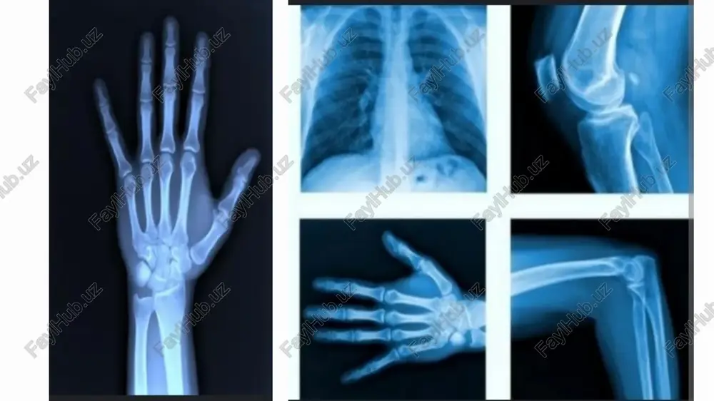urli burchaklardan olingan bir nechta rentgen oʻlchovlari tomografik (kesimdagi) tasvirlarni (virtual „boʻlaklar“) ishlab chiqarish uchun tomografik rekonstruksiya algoritmlari yordamida kompyuterda qayta ishlaydi. magnit-rezonans tomografiya (mrt) kontrendikedir boʻlgan metall implantlar yoki yurak stimulyatori boʻlgan bemorlarda kompyuter tomografiyasidan foydalanish mumkin. 1970-yillarda ishlab chiqilganidan beri kt skanerlash koʻp qirrali tasvirlash usuli ekanligini isbotladi. kt tibbiy diagnostikada eng koʻp qoʻllanilsa-da, u tirik boʻlmagan obyektlarning tasvirlarini yaratish uchun ham ishlatilishi mumkin. 1979-yilda fiziologiya yoki tibbiyot boʻyicha nobel mukofoti janubiy afro-amerikalik fizik allan makleod kormak va britaniyalik elektrotexnika muhandisi godfrey xounsfildga „kompyuterli tomografiyani rivojlantirish uchun“ birgalikda berildi. kt aparatining turlar: ketma ket kt spiral kt. ikki energiyali kt. pektkt. ketma-ket kt bosqichli kt sifatida ham tanilgan ketma-ket kt bu kt stoli bosqichma-bosqich harakatlanadigan skanerlash usulining bir turi. kt stoli maʼlum bir joyga koʻtariladi, soʻngra rentgen trubkasi aylanishi va kesim olish bilan toʻxtaydi. keyin kt stoli yana suriladi va yana bir boʻlak olinadi. bu skanerlash vaqtini oshiradi …