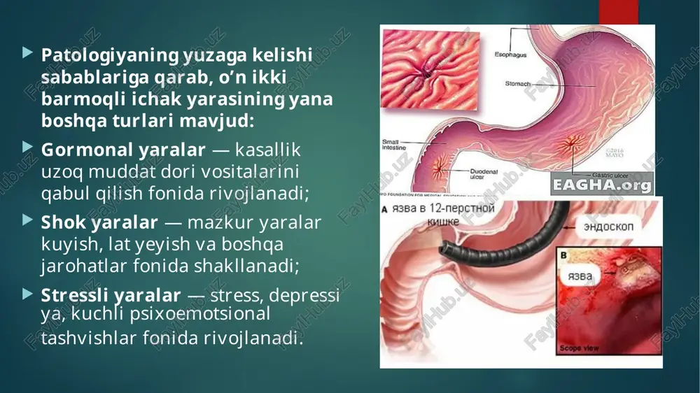 iloji bo’lsa undan umuman voz kechish; ovqatlarni ezilgan holda qabul qilish tavsiya etiladi, xuruj davrida bu majburiy shart hisoblanadi. mevalar va rezalar faqat to’liq pishgan va yumshoq po’stloqli bo’lganda iste’mol qilishga ruxsat beriladi; shirin sharbatlar (masalan, malina, shaftoli, qulupnay) albatta suv bilan aralashtirilgan bo’lishi kerak. medikamentoz terapiya ushbu kasallikda dori-darmonlar asosan kasallikning xuruji davrida qabul qilinadi. bunday dori vositalariga quyidagilar kiradi: antasidlar — ular me’da shirasining nordonlik darajasini pasaytiradi; antisekretor preparatlar — ishlab chiqariladigan oshqozon shirasi miqdorini kamaytiradi; antibakterial vositalar (antibiotiklar) — patogen bakteriyalarni / mikroorganizmlarni yo’q qilish uchun. xuruj davrida kasallikni davolash muddati 2-5 hafta bo’lib, ko’pincha bu vaqt ichida bemorlar kasalxonada yotadilar. agar bemor kuchli og’riqdan shikoyat qilsa, unga spazmolitiklar (masalan, no-shpa), uzoq muddatli qabziyatda — ich yumshatuvchi vositalar yoki xuqnalar buyuriladi. etiboringiz uchun rahmat! image6.jpeg image7.jpeg image8.jpeg image9.jpeg image10.jpeg image11.jpeg image12.jpeg image13.jpeg image14.jpeg image15.jpeg image16.jpeg image2.png image3.png image4.png image5.png apehaquatunepcrhan eagha.org a 9364 8 12-nepcthol 3haockon /docprops/thumbnail.jpeg …