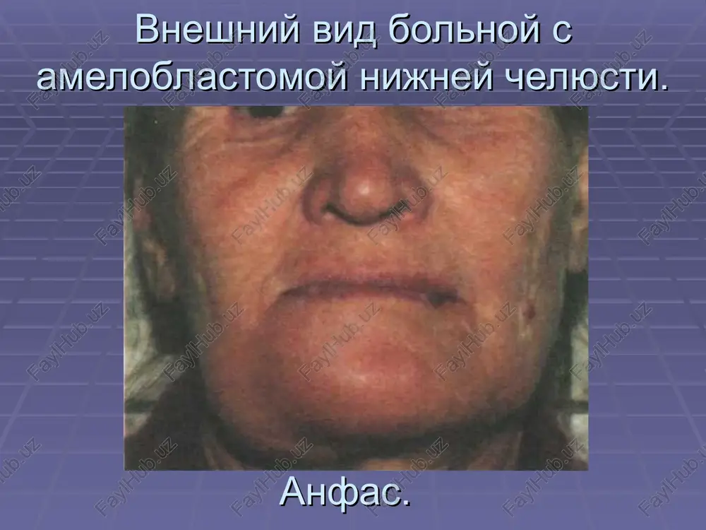 ameloblastoma - Page 4