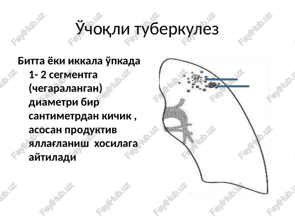 rox kasalliklar(qandli diabet, 12-barmoq ichak yara kasalligi); alkogolizm, tamoki chekish, narkomaniya o'choqli tuberkulezni tasnifi: kelib chiqishi bo'yicha: birlamchi (mustaqil turi); boshqa klinik formalarni yakuni sifatida morfologik va rentgenologik ko'rinishi bo'yicha: yumshoq o'chrqli; fibroz- o'choqli o'chog'ni o'lchami bo'yicha: miliar ( 2 mmgacha) mayda (2-4 mm) o'rtacha (4- 6 mm) yirik ( 1 smgacha) lokalizatsiya bo'yicha: yuqori segmentlarda (s 1. 2) va pastki bo'lagini(s 6) segmentida yumshoq o'choqli tuberkulez chap o'pkani yuqori bo'lagida o'mrov ostida bir nechta yirik, chegarali noaniq, intensivligi o'rta yumshoq o'choqli tuberkulez (abrikosov o'choqli) ashoff – pul o'choqlari o'choqli tuberkulezni kechish xususiyati: klinik belgilari sust yoki umumman bo'lmaydi, shu sababli aksariyat bemorlar flyuorografiya tekshiruvda aniqlanadi. bemorlarni uchdan birida intoksikatsiya sindromi va nafas yo'llarini zararlanish sindromi sust rivojlanadi intoksikatsiya belgilari: subfebril isitma kechqurunlari, tana qizishi, o'qtin- o'qtin junjikish, ko'p terlash, xolsizlik, ishtaxa pasayishi, uyqu buzilishi. ba'zi xollarda o'choqli tuberkulez kechishi gipertireozga o'xshab ketadi: qalqonsimon bezni kattalashuvi, taxikardiya, ko'zlar yiltiraydi, tana …
