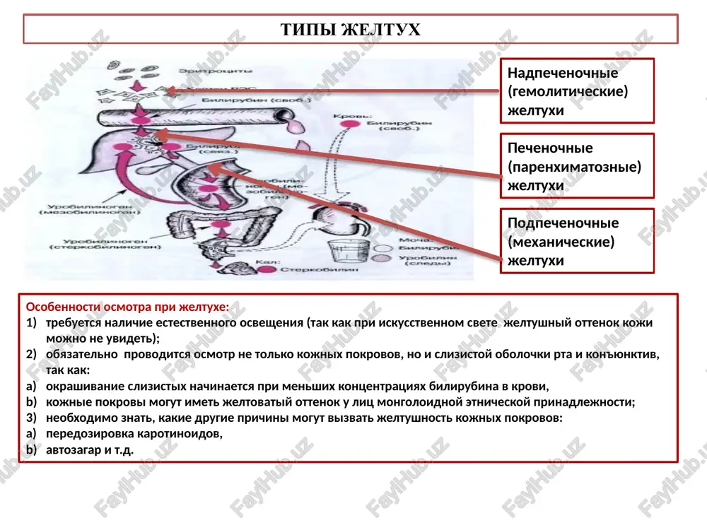 bolee svetlim. nalichie drugix pechenochnix sindromov. mexanicheskaya jeltuxa: prichini, mexanizmi razvivaetsya pri obturatsii vnepechenochnix jelchevivodyashix putey kamnem ili sdavleniem obshego jelchnogo protoka opuxolyu (rak golovki podjeludochnoy jelezi ili faterova soska, metastazi raka v limfaticheskie uzli vorot pecheni), chto soprovojdaetsya povisheniem davleniya vo vnutripechenochnix jelchnix protokax. jelch ne videlyaetsya v kishechnik i ne obrazuyutsya urobilinogeni. v krovi vozrastaet uroven konyugirovannogo (pryamogo) bilirubina. vsasivayutsya v krovotok drugie komponenti jelchi, ne postupayushie v kishechnik: jelchnie kisloti, xolesterin, fosfolipidi i t.d. mexanicheskaya jeltuxa, klinicheskie proyavleniya koja olivkogo tsvetv - za schet povisheniya konyugirovannogo (pryamogo) bilirubina i drugix sostovlyayushix komponentov jelchi. na koje mogut bit raschesi iz-za razdrajayushego vozdeystviya komponentov jelchi, postupayushix v sistemniy krovotok i v koju. povishenniy pryamoy bilirubin legko proxodit pochechniy barer i poyavlyaetsya v moche, obuslavlivaya ee temnuyu okrasku (mocha «tsveta piva»). v kale sterkobilin otsutstvuet (tak kak bilirubin ne postupaet v kishechnik i ne obrazuetsya, sootvetstvenno, urobilinogen), poetomu kal obestsvechen. …