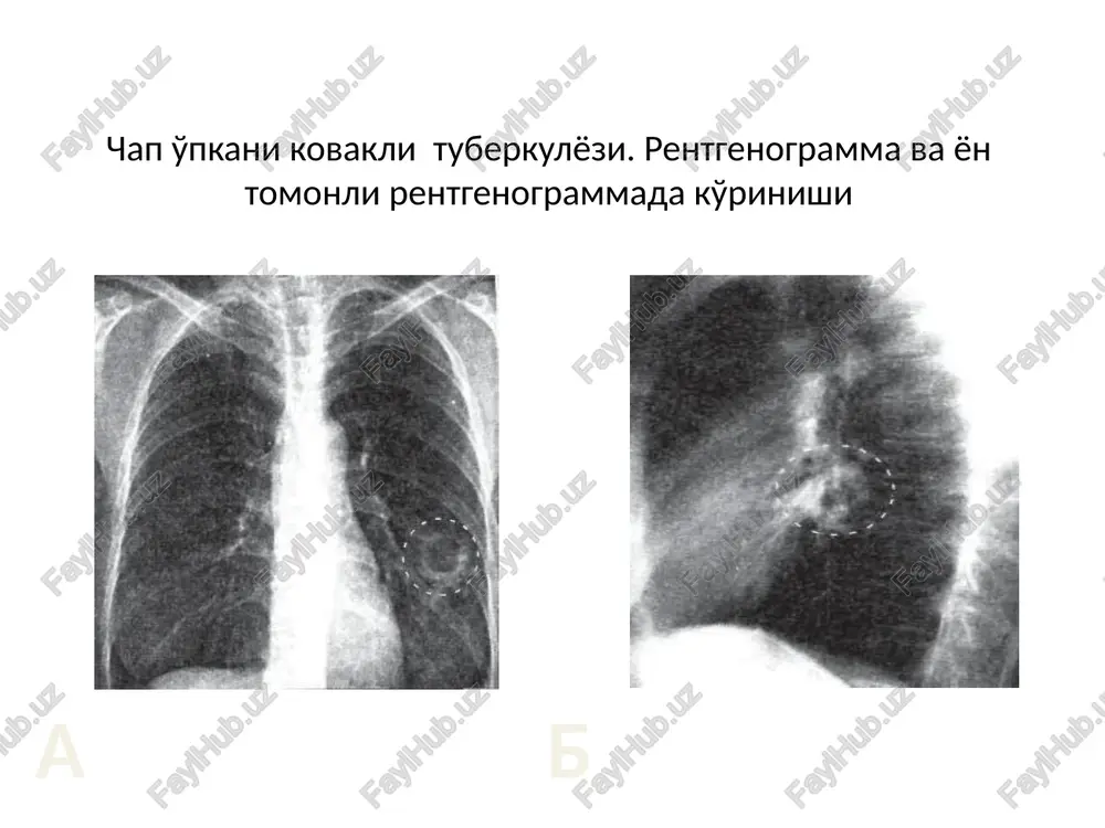 o'pkani kovakli tuberkulezi - Page 4