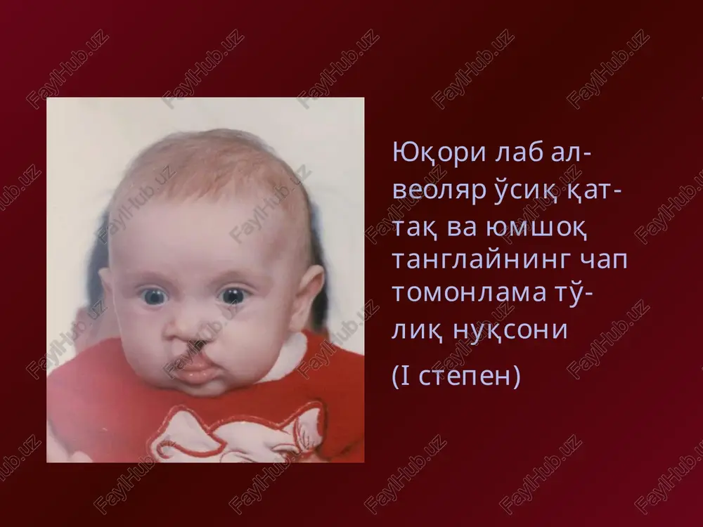 ujini. monolitnie obturatori. naibolee udachnim v chasti vosstanovleniya funktsii rechi obturatorom yavilas konstruktsiya syuersena (1867). obturatori s podvijnoy nebnoy zanaveskoy. obturator shildskogo (1885), sostoit iz opornoy plastinki ili zubnogo proteza, ot zadnego kraya kotorogo otxodil vistup s prujinoy, na zadnem kontse kotoroy ukreplyalas obturiruyushaya chast iz vulkanizirovannogo kauchuka. danniy obturator ne vizival atrofii kraev defekta i imitiroval dvijeniya myagkogo neba naibolee ratsionalnimi i effektivnimi konstruktsiyami priznani plavayushie obturatori, kotorie izgotavlivayut v pervie dni posle rojdeniya rebenka. plavayushie obturatori. nedostatkom bolshinstva obturatorov s klammernoy fiksatsiey yavlyaetsya peregruzka opornix zubov i zaderjka rosta verxney chelyusti, a nedostatkom obturatorov s prisasivayushey fiksatsiey – vozniknovenie zastoynix yavleniy i giperplazii slizistoy obolochki, chto mojet privesti k ozlokachestvleniyu. obturator uderjivaetsya blagodarya tochnomu prileganiyu k slizistoy obolochke nosovoy i rotovoy poverxnostey kraev rasshelini tverdogo neba i osobomu polojeniyu iskusstvennoy nebnoy zanaveski po otnosheniyu k glotochnim i nebnim mishtsam. vtoroe ego dostoinstvo – legkost. spasibo za vnimanie ! …