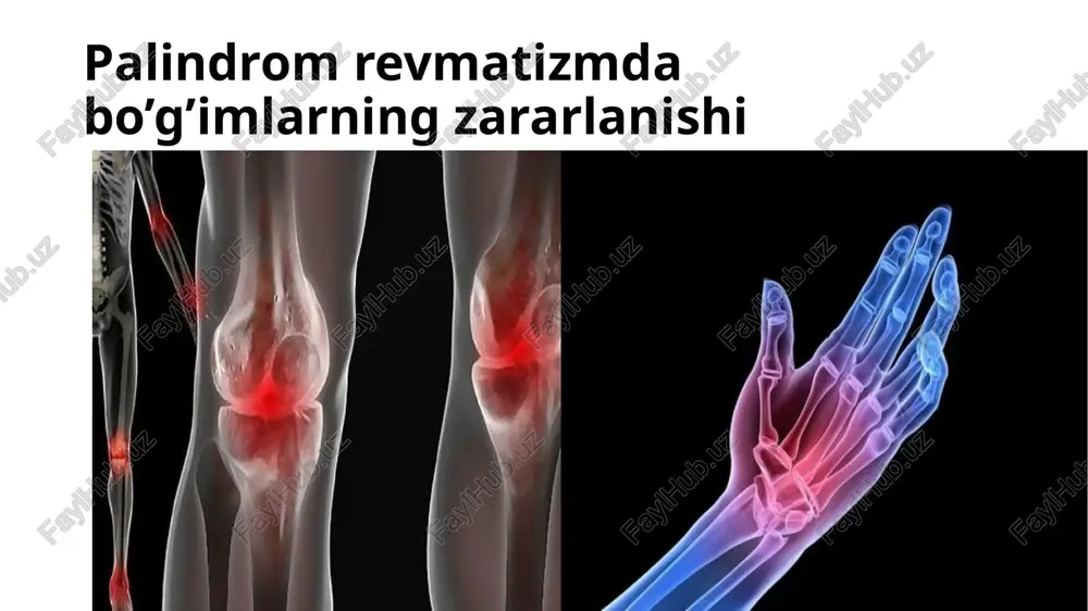 da ko‘z sohasiga salbiy ta’sir ko‘rsatishi mumkin, shuning uchun oftalmologik nazorat talab etiladi. . kolxisin maqsad: yallig‘lanish xurujlarini kamaytirish va takrorlanish oldini olish. doza: 0,5–1 mg kuniga 1–2 marta. qo’shimcha tavsiyalar ✅ fizioterapiya – bo‘g‘imlarning harakatchanligini saqlash uchun. ✅ parhez – yallig‘lanish jarayonini kamaytirish uchun omega-3 yog‘ kislotalari va antioksidantlarga boy ovqatlar iste’mol qilish tavsiya etiladi. ✅ hayot tarzini o‘zgartirish – stressni kamaytirish, muntazam jismoniy faollik va ortiqcha vazndan qochish muhim. image1.png image2.png image3.png /docprops/thumbnail.jpeg toshkent tibbiyot akademiyasi 1-davolash fakultet 412-a guruh talabasi xudoyaulove zarnigor