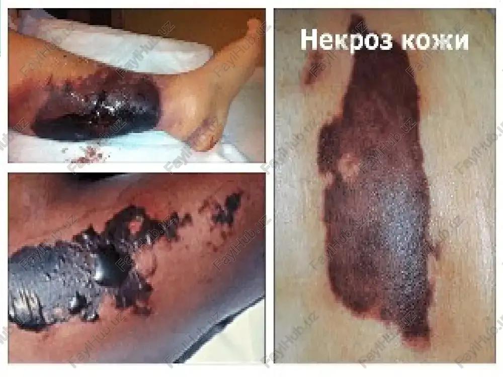 a aylanadi. parchalanish mahsulotlari so'rilib organizmni og'ir zaharlaydi. demarkatsion chiziq odatda bo'lmaydi, gohida jarayon cheklangan hollarda granulyatsion to'siq shakllanadi. klinik manzarasi. kasallik tezda zo'rayib boradi. oyoq avvaliga oqaradi, muzlaydi, keyin ko'kimtir-qizil dog'chalar paydo bo'ladi, epidermis qatlam-qatlam bo'lib ko'chadi, qo'lansa hidli, qon aralash ekssudatli pufakchalar hosil bo'ladi. to'qimalar juda ham shishib ketadi, zararlangan oyoqda qattiq og'riq turadi. kasallik rivojlangan og'ir umumiy intoksikatsiya ro'y beradi. bemorning tashqi qiyofasi o'zgaradi, tili quriydi, tomir zaif va to'liq urmaydi, qon bosimi pasayadi, to'liq apatiya kuzatiladi. harorat ko'tarilib, gektik xususiyatga ega bo'ladi, leykotsitoz kuzatiladi. davosi. qon tomiri emboliyasida kechiktirilmay operatsiya yo'li bilan to'siqni olib tashlash va qon aylanishini tiklash yaxshi natija beradi. lekin vaqt kechiksa va qorason (gangrena) boshlangan bo'lsa, umumiy davolash prinsipi intoksikatsiyaga va infeksiyaga, moddalar almashinuvining buzilishini bartaraf etishga qaratiladi. katta miqdorda kritalloidlar (natriy xloridning izotonik eritmasi, glyukozaning 5-10 foizli eritmasi) yuboriladi, qon, plazma, qon o'rnini bosuvchi suyuqliklar (gemodoz, jelatinol, kam molekulyar poliglyukin) qo'yiladi, …