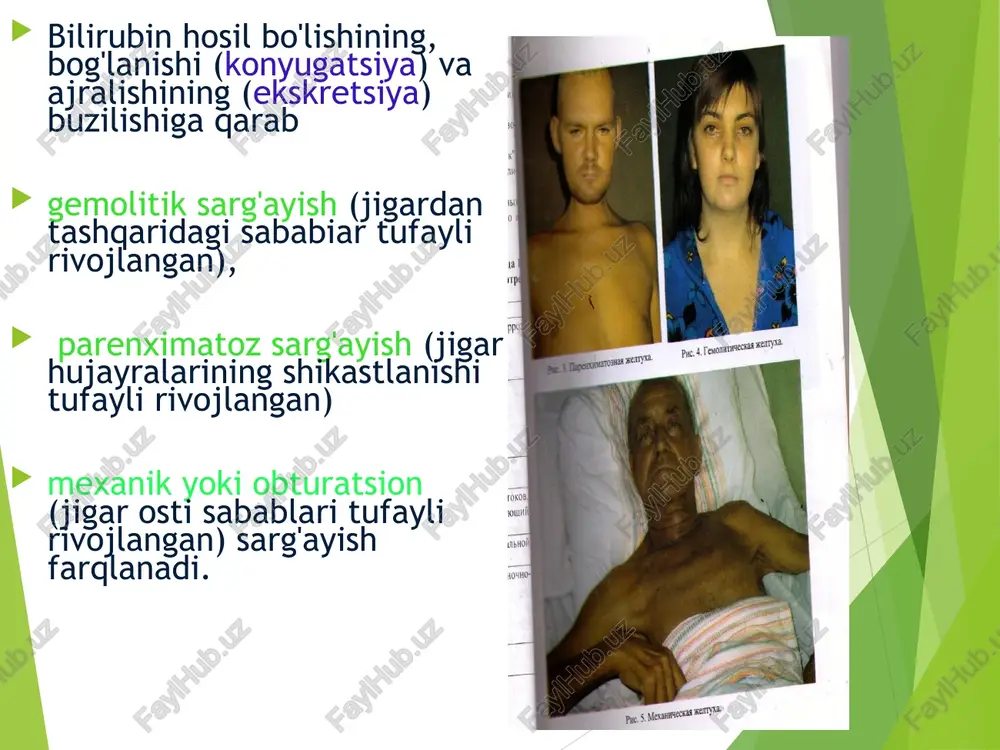 qaridan qisilishi va bosilishi tufayli (jigarning birlamchi va metastatik raklarida, oshqozon osti bezi, oddi sfinktri, faterov so'rg'ichi, 12 barmoq ichak, limfatik tugunlar rakida umumiy o't yo'iining pankreato-duodenal zonada bajarilgan operatsiyadan so'ng chandig' bilan qisilib qolishi tufayli. o't yo'llarining atreziyasi mexanik sarg'ayish asosan 40 yoshdan oshgan odamlarda uchraydi va unga ko'pincha og'riq bo'lishi xos bo'ladi. o't tosh kasalligida og'riq hurujsimon bo'lib, o'ng qovurg'a sohasida bezovta qiladi, o'ng kurakka va elkaga uzatiladi. og'riq o't yo'ilari mushaklarining qisqarishi sababli yuzaga keladi. og'riq hurujidan keyin obturatsion sarg'ayish rivojianishi mumkin. oshqozon osti bezi rakida rivojlangan obturatsion sarg'ayishda og'riq bemorlarning 40-80% bo'ladi, epigastral sohada, o'ng va chap qovurg'a ostida bezovta qiladi, belga, kurakka uzatilishi mumkin. obturatsion sarg'ayishning boshqa belgilariga dispeptik simptomlar - ko'ngil aynishi, qusish, ishtahaning pasayishi, hamda ich kelishining buzilishi, ozib ketish kiradi. boshqa belgilar sifatida ko'pincha harorat ko'tarilishi kuzatiladi. ko'ruvda gepatomegaliya, kurvuaze belgisi, kuchli sarg'ayish, terining qichishi aniqlanadi. giperbilirubinemiya qonda asosan bog'langan bilirubin hisobiga …