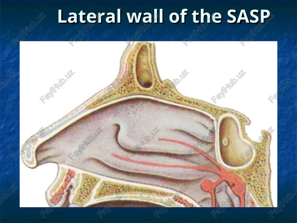 trichloroacetic acid; principles of nasal bleeding at moderate - front tamponade; with strong - back tamponade, ligation of common carotid artery; medications - increase blood clotting, blood transfusions, oxygen therapy the front nose tamponade plugging produce orderly laying loops turundy impregnated with an ointment to the bottom of the nose of his entry to the posterior nares. stages of the back of the nose tamponade holding the catheter at the bottom of the nose into the nasopharynx and removal of the distal end through the mouth fixation pad to the distal end of the catheter stages of the back of the nose tamponade summing up the pad to the choanal and pressing a finger fixation pad at the front edge of the nose clinical forms of sinusitis acute; chronic; classification of sinusitis exudative form: bluetongue, serous, purulent; productive: wall-hyper-plastic, polypous, cystic; alternative - holesteotomnaya, caseous, necrotic, atrophic; mixed forms - …