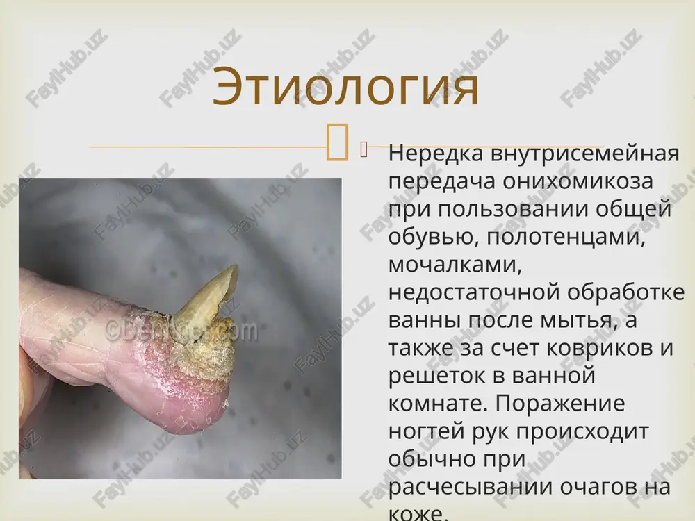 po dvum sxemam: po 200 mg ejednevno v techenie 3 mes ili po 200 mg dvajdi v den v techenie 7 dney na pervoy, pyatoy i devyatoy nedelyax. pri porajenii bolshix paltsev stop rekomenduetsya provodit 4-y kurs puls-terapii na trinadtsatoy nedele ot nachala terapii. dlya lecheniya onixomikozov u detey itrakonazol ne primenyaetsya. kompleksnaya terapiya  kriteriyami mikologicheskoy izlechennosti onixomikoza yavlyayutsya otritsatelnie rezultati mikroskopicheskogo i kulturalnogo issledovaniya nogtevoy plastinki. posle okonchaniya lecheniya itrakonazolom i terbinafinom zdorovie nogtevie plastinki otrastayut ne polnostyu, poetomu polnoe klinicheskoe vizdorovlenie mojno nablyudat tolko spustya 2–4 mes posle okonchaniya priema antifungalnix preparatov. prognoz  image4.jpeg image5.jpeg image6.jpeg image7.jpeg image8.jpeg image9.jpeg image10.png image11.gif image12.jpeg image13.jpeg image14.jpeg image15.jpeg ohmxommko3 1 2 3 ctayqwm ohuxomhko03a, mike ptpocbrsec kui th ohircompr obs eonacvn <4 mukocnop’ ha6op ma3b ana hapyhoro npumenexua ~~ minierpyxuna no hahecehito maan by mincocnop" wa op mag® ana hapyxrioro npnmenexnn wasserfeste pflaster waterproof plaster emplatre résistant a l'eau …