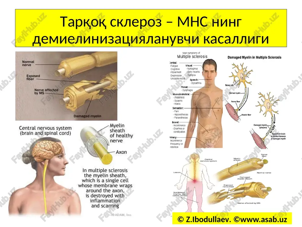 ldini olish uchun:rebif, kopakson, azatiopirin kasallik qo'zg'alganda: kortikosteroidlar, plazmaferez metabolik terapiya: aminokislotalar, vitaminlar simptomatik terapiya: midokalm, sirdalud, karbamazepin, klonazepam, sibazon, fevarin interferonlar bilan davolash nomi qo'llash usuli beta-interferon-1b (betaferon, betaseron) . 0,25 mg (8 mln hb) teri ostiga qilinadi. beta-interferon-1a ( avoneks) 30mkg (6 mln xb) muskul ichiga qilinadi. beta-interferon-1a (rebif) 22 mkg (22 mln xb) teri ostiga qilinadi. © z.ibodullaev. ©www.asab.uz kopakson (glitamer atsetat) kopakson 20 mg dan teri ostiga har kuni yoki kunora qilinadi. dori bilak, kindik atrofi yoki sonning teri ostiga yuboriladi. dori qilinadigan joy o'zgartirib turilishi kerak. aks holda ukol qilingan joyda nekroz hosil bo'ladi. kopakson bilan davolashni bir necha yillar mobaynida olib borish mumkin. © z.ibodullaev. ©www.asab.uz kortikosteroidlar bilan davolash sxemasi kunlar tavsiya etiladigan dozasi va usullari 1-5 500-1000 mg kuniga bir mahal venadan tomchilatib yuboriladi. 6-8 80 mg ertalab ichish uchun beriladi. 9-11 60 mg ertalab ichish uchun beriladi. 12-14 40 mg ertalab ichish …
