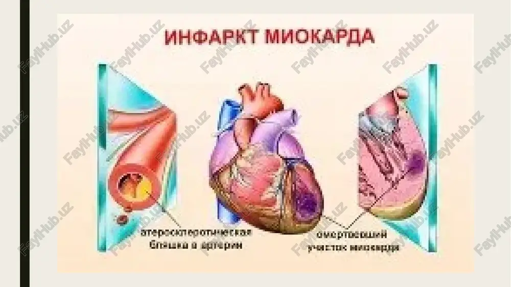 arni suiste’mol qilish yurak-qon tomir kasalliklari rivojlanish xavfini sezilarli darajada oshirishini isbotlashgan. yomon odatlardan voz kechishni istamagan odamlarda miokard infarktining rivojlanishi xavfi 2 barobar ortadi. qonda xolesterin miqdorini nazorat qilish. 45 yoshdan oshgan barcha insonlarga yog’lar almashinuvini muntazam ravishda nazorat qilish tavsiya etiladi, chunki u buzilganda rivojlanadigan ateroskleroz yurak-qon tomir kasalliklarining asosiy sabablaridan biridir. miokard infarktini kasalxonada davolash qon aylanishini va toj arteriyalar o’tkazuvchanligni tiklashning eng yaxshi usuli — darhol tomirning angioplastikasini o’tkazishdir, bu vaqtda arteriya ichiga maxsus stent kiritiladi. stent qo’yish miokard infarktining boshlanishidan keyingi dastlabki soatlarda ham talab qilinadi. ba’zi hollarda yurak mushaklarini saqlab qolishning yagona yo’li shoshilinch toj arteriya shuntlash operatsiyasino o’tkazish hisoblanadi. miokard infarkti bilan og’rigan bemor intensiv terapiya bo’limiga yotqiziladi. kerak bo’lganda reanimatsiya bo’limiga yotqizilib, u yerda maxsus apparatlar yordamida shifokorlar bemorning holatini nazorat qilib turishadi. qon bosimini nazorat qilish. qon bosiming doimiy ravishda 140/90 mm. sim. ust. dan yuqori bo’lishida uni dori-darmonlar bilan me’yorga …