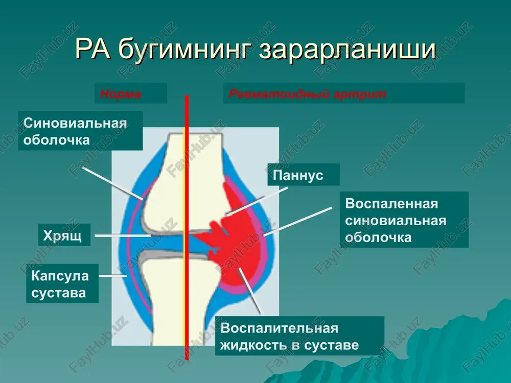 ta'rif 1.ertalabki shaxtlik. 2.uch va undan ortik bo'g'imlarning zararlanishi. 3.qo'l panja bo'g'im artriti. 4.simmetrik artrit. 5.revmatik tugunlar. 6.qon zardobida revmatik faktor musbat. 1.bo'g'imlarda ertalabki shaxtlik bemorlarda olti xavtagacha davom etib shaxtlikning davomiyligi 1-soatgacha. 2.periartikulyar yumshok to'kimalarning shishi, bo'g'im bo'shlig'ida suyuqlik to'planishi. 3.quyidagi bugimlarning qaysidir gruppasida shish bulishi: falangalar aro proksimal plyunofalangali bo'g'imda yoki bilak bo'g'imida. 4.yuqorida ko'rsatilgan bugimlarning bilateral zararlanishi. 5.bo'g'imlarning egiluvchi kismida teri osti tugunlarining topilishi. 6.qon zardobida rf topilishi. revmatoid artiritning tashxis mezonlari (a.r.a) 1. oxirgi 6 xafta davomida 1 soat davom etuvchi ertalabki karaxtlik 2. oxirgi 6 xafta davomida 3 yoki undan ortiq bo'g'imlarda shish 3. oxirgi 6 xafta va undan ko'p vaqt davomida kaft-barmoq va proksimal falangalararo bo'g'imlarda shish 4. bo'g'imlar jaroxatlanishining simmetrikligi 5. bo'g'imlarda tipik rentgenologik o'zgarishlar (zroziyalar, bo'g'im oldi osteoporozi) 6. teri osti revmatoid tugunchalari 7. qon zardobida revmatoid omil aniqlanishi laborator tekshirish usullari 1. konning umumiy taxlili: - normoxrom kamkonlik; - kuchli va …