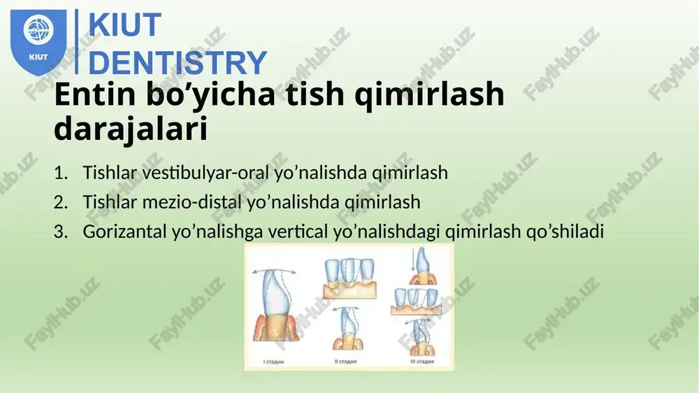 ’lgan chandiq va tortilishlarni bartaraf qilish og’iz dahlizi va og’iz tubini chuqurlashtirish kiut dentistry alohida turgan yakka tishlarni olishga ko’rsatmalar: paradont kasalligi tufayli uchinchi darajali qimirlash bo’lganda tish toj qismining klinik balandligi unung ildiziga nisbatan mos bo’lmasligi o’z joyidan siljiganligi va periodontda, ildiz uchida surunkali o’choq bo’lishligi o’z joyidan siljigan tishda karies tufayli tish tojining ko’p qismi yo’qotilganligi tishning vertikal yo’nalishda me’yoridan ortiq siljishi va uni charxlanishi toj qismini yo’qotilishiga olib kelishi mumkinligi tishning defect tomonga egilganligi, ortodontik va protezlash usullari bilan ham ko’prisimon olib-qo’yilmaydigan qoplamaga tayanch bo’la olmasligi(parallelikni ta’minlashni iloji bo’lmaganda) kiut dentistry alveolyar o’siqning gipertrafiyasi kuzatilganda tish olish bilan bir qatorda uni qisman rezeksiya qilishga to’g’ri keladi. alveolyar o’siqning to’g’ri shakliga ikkita uslubda erishish mumkin: ma’lumki tish olinsa, turtib turgan suyak va alveolyar o’siq o’tkir qirralari vaqt o’tishi bilan atrofiyaga uchraydi va silliqlanadi, shuning uchun ba’zi ortopedlar tish olingandan so’ng protezlashgacha 1,5-2 oy kutishadi, yuqoridagi o’zgarishlar bo’lgunga qadar. …