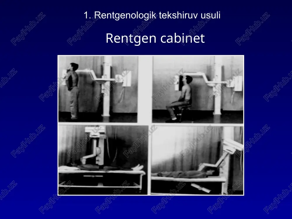 - kattalardagi sinishlar - bolalardagi sinishlar, - patologik sinishlar. yoriqlar ajralib turadi: - to'liq va qisman (yoriqlar); - oddiy: - ko'ndalang; - qiyshiq; - spiral; - murakkab: - x shaklidagi, t shaklidagi, y shaklidagi; - intraartikulyar, o'q otish, ochiq. singanlarning rentgenologik belgilari: - yorishish chizig'i; - qorayish chizig'i; - suyak bo'laklarining siljishi. suyak sinishlari sxemasi yelka jarrohlik bo’yinchasi sohasidagi ta'sirlangan sinish (diagramma va rentgenogramma) parchalarning bir-birining ustiga chiqishi sababli qorayish chizig'i ularning kirishi va lateral siljishi tufayli spiral sinish tibia va qiya sinish fibula boshsuyagi suyaklaridagi yoriqlar (impression sinish) suyak qismlarini siljish turlari: - eksenel (divergentsiya, xanjar, bo'laklarni kiritish bilan), - lateral, - burchak, - aylanuvchi. varianti smesheniya kostnix otlomkov (sxema): uglovoe, bokovoe, rotatsionnoe, osevoe, epifizeoliz oyoq kaft bo’g’imi - "trimalleolyar" sinish periferik bo'laklarning yon tomonga siljishi bilan diafizning o'rta uchdan bir qismida ikkala tibia suyagining qiya sinishi murakkab sinish - ikkita suyak shikastlangan murakkab sinishlar - o'q otish sinishi: …