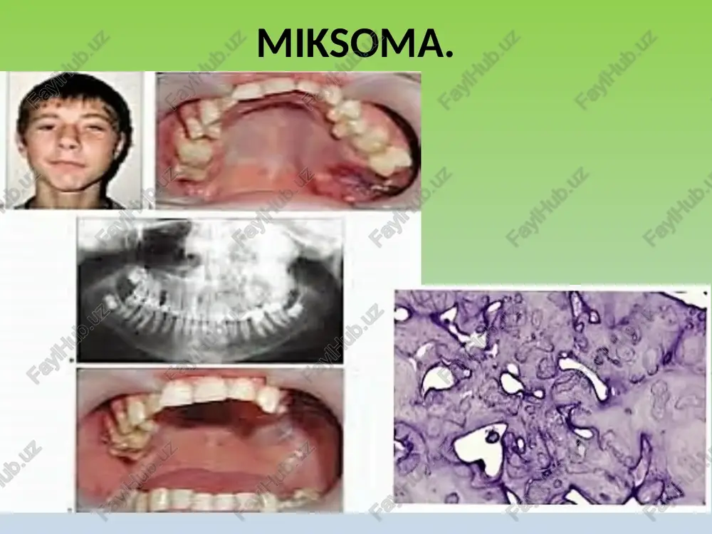 m katta bo’lmagan ko’p sonli qon tomirlari bilan fibroblastlar va kollagen tolalar ) 2. biriktiruvchi to’qima orasida joylashgan suyak ustunchalari va sementsimon qismlar. 1. 2 gigant sementoma kam uchraydi, ko'payish o’chog’i kop sonli bo'lishi mumkin va irsiy kasallikdir. gigant sementoma odontogen aralash o’smalar. № xavfsiz odontogen aralash o’smalar 1 ameloblastik fibroma 2 odontogen fibroma 3 odontoameloblastoma 4 ameloblastik fibroodontoma xavfli odontogen aralash o’smalar (odontogen sarkomalar) ameoblastik fibrosarkoma ameloblastik odontosarkoma ameloblastik fibroma. proliferatsiyalanuvchi odontogen epiteliy orolchalaridan va tish so’rg’ichi to'qimalarini eslatuvchi, siy-rak tolali biriktiruvchi to'qimalardan ibo-rat. ushbu o'simta bolalar va yoshlarda ko’p-roq uchraydi va premolyarlar sohasida joy-lashadi. odontogen fibroma. faol bo'lmagan odontogen epiteliy va yetuk (shakllangan) biriktiruvchi to'qima orollaridan tarkib topgan. bu o’sma asosan katta yoshli insonlarda ko’proq uchraydi. odontoameloblastoma. odontoameloblastoma juda kam uchray-digan neoplazma. ameloblastomadagi kabi odontogen epiteliy hamda emal va dentin orollaridan tarkib topadi. ameloblastik fibroodontoma. ameloblastik fibroodontoma ham yoshlar-da ko’proq uchraydi. gistologik jihatdan u ameloblastik fibro-maga o'xshaydi, ammo …