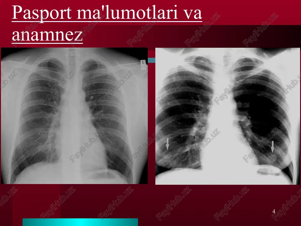 tijalari bilan bog'liq tashxis qo'ying ko'krak qafasining rentgenogrammasini qanday ko'rish kerak * foydalanilgan adabiyotlar chest x-ray made easy - corne, carroll & delany, 2001. chest roentgenology. benjamin felson, m.d. essentials of radiology. fred a. mettler jr. m.d.; second edition, 2005. the abc’s of heart disease. william herring, m.d. 2000 obshee rukovodstvo po radiologii, holger peterson, 1995. radiologiya – praktika. 2001 № 1 rentgenodiagnostika zabolevaniy organov golovi, shei i grudnoy kletki, v.v.yakovets, 2005. resursi interneta