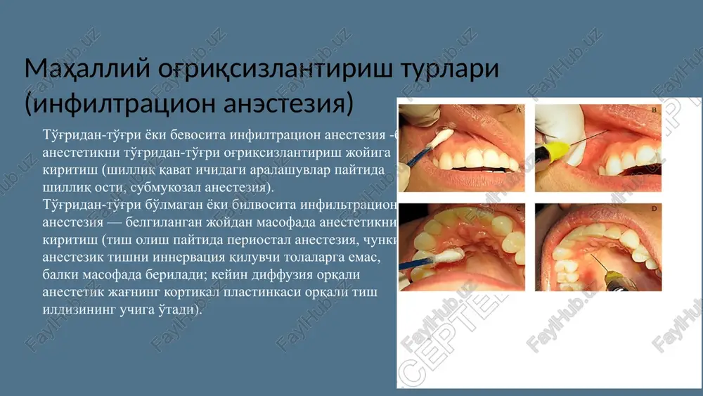 chiqmasligi uchun yana 10-15 soniya kuting; * tish olish operatsiyasi paytida ignani chuqurroq siljitish va periodont tolalarni tish ildizidan ajratish uchun anestetikni tezda chiqarish mumkin. 11 pulpaichi anesteziyasi bajarilish joyi- pulpa toj qismi yoi ildiz pulpasi. ko'rsatma - - pulpitni davolashda qo'shimcha og'riqsizlantrish usuli. instrument - karpul shprits kalta yupqa ninali (d=0,3 mm, dlina=10 mm), in'ektor is-01-1. texnikasi: 1variant. • tish bo'shlig'ining ochilishi bir nuqtada amalga oshiriladi, • bosim ostida pulpa kamerasiga ochiq nuqtasi orqali 0,1 ml anestezik yuboriladi, teshik igna diametriga to'g'ri kelishi kerak, • anesteziya 30-60 sekunddan so'ng vujudga keladi. 12 2 variant. • tish bo'shlig'i ochiladi, • bo'shdiqni 1 daqiqa davomida anestetik eritmasi bilan to'ldiriladi, • toj pulpasi markaziga igna sanchiladi va 0,1 ml anestetik yuboriladi, kerak bo'lganida ignani kamroq egiladi, • anesteziya 30-60 sekunddan so'ng paydo bo'ladi. toj pulpasini amputatsiya qilgandan so'ng, ildiz pulpasini anesteziya qilish boshlanadi. bunda igna kanalga kiritilib, 0,06 ml anestetik yuboriladi (is-01-1 …