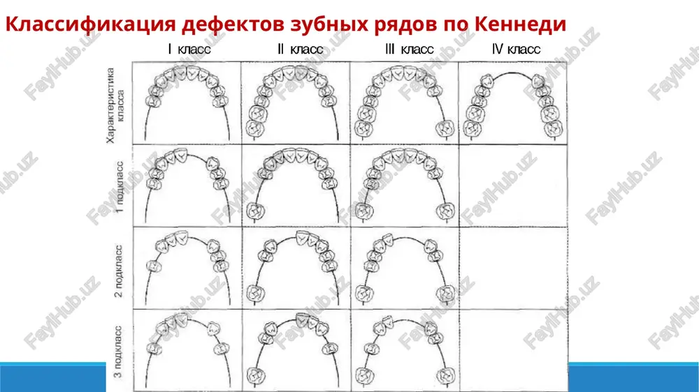 ornogo zuba, vnedrenie tela mostovidnogo proteza v slizistuyu obolochku s obrazovaniem prolejney, otlom tela mostovidnogo proteza. pri konstruirovanii mostovidnix protezov s odnostoronney oporoy (konsolnix) sleduet: tshatelno viravnivat okklyuzionnie vzaimootnosheniya, ne modelirovat iskusstvenniy zub ne shire premolyara, dlya opori ispolzovat ne menee dvux zubov, telo proteza doljno bit predstavleno ne bolee chem odnim iskusstvennim zubom. konsolnie protezi nelzya primenyat pri boleznyax parodonta, nizkix klinicheskix koronkax zubov. polojitelnie kachestva mostovidnix protezov: • vosstanovlenie tselostnosti zubnogo ryada; • vosstanovlenie funktsii jevaniya i rechi; • vosstanovlenie esteticheskix norm; • bolee komfortni, chem s'emnie protezi; • proisxodit naibolee bistroe privikanie po otnosheniyu k s'emnim protezam. mostovidnie protezi imeyut sleduyushie nedostatki: 1) neobxodimost preparirovaniya intaktnix zubov pod opornie elementi: 2) vozmojnost funktsionalnoy peregruzki parodonta zubov pri nepravilnom vibore konstruktsii proteza i kolichestva opornix zubov; 3) zatrudnenie gigienicheskogo uxoda za protezom v svyazi s nes'emnostyu konstruktsii; 4) vozmojno razdrajayushee deystvie kraya iskusstvennoy koronki na kraevoy parodont. s'emnie …