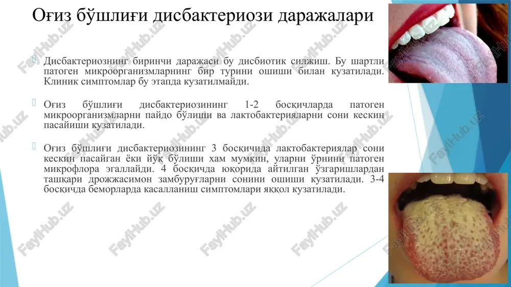 kandidalar bilan zararlanishi uchrab turadi. og'iz bo'shlig'i kandidozi giperemiyalangan, quruq va og'riqli shilliq qavatda oq rangli, engil ko'chadigan karash hosil qilishi va karash ko'chirilganda, shilliq qavatda eroziyalangan sohalarni aniqlanishi bilan tavsiflanadi. yana shuni ta'kidlash lozimki, candida ko'pincha turli bakterial infektsiyalarda (surunkali tonzillit, ichburug', bo'g'ma va bo'g'ma qo'zg'atuvchisini tashuvchilik) mikroblar assotsiatsiyasida ham ishtirok etadi. bunday assotsiatsiyalarda, candida boshqa mikroblar patogenligini namoyon qilishida qatnashib, yuqumli kasallikning asoratlanishiga olib keladi. yuza zamburug'li infektsiyalar (mikozlar) ko'pincha immuntanqisligi bor odamlarda uchraydi. eng ko'p uchraydigan yuza mikoz – bu og'iz bo'shlig'i kandidozdir. oiv-infektsiyali bemorlar og'iz bo'shlig'ida yuza mikozni keltirib chiqaruvchi zamburug'lar candida turlari boshqa zamburug'lar c. albicans saccharomyces cerevisiae c. glabrata rhodotorula rubra c. famata rhodotorula piliminae c. kefyr fonsecaea pedrosi c. krusei prototheca stagnura c. rugosa trichosporon pullulans c. tropicalis c. guiliermondii og'iz bo'shlig'i kandidozi – oiv-infektsiyasining ilk belgisi va oits rivojlanishini xabarchisi. og'iz bo'shlig'i kandidozi immun tizimning boshqa t-hujayrali nuqsonlarida ham uchraydi, lekin oiv …