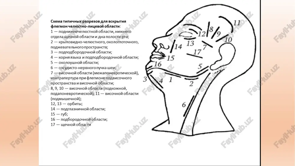 hakka osti abstsessi va flegmonasi bo'lgan bola statsionar sharoitda davolanishi lozim. yiringli o'choq narkoz ostida ochiladi, sababchi tish olinadi. operatsiya texnikasi: bemorning boshi orqaga tashlangan holda yotkiziladi. og'iz keng ochiladi. retromolyar sohaga tamponlar qo'yilib, yuqori jag' do'ngi proektsiyasi chaynov tishlari sohasida o'tuv burmasi suyakgacha kesiladi. “moskit” qisqich yordamida, yuqori jag' do'ngini sezgan holda, orqaga–yuqoriga–ichkariga, pastki jag' shoxi o'siqlari orasidagi o'yiqqacha kengaytiriladi. yara antiseptiklar bilan yuvilib, ichida rezina chiqargich qoldiriladi. yallig'lanish jarayoni qanot – tanglay chuqurchasiga tarqalmasligi uchun chiqargich yara gumbaziga etkazilib kiritiladi, ajralma batamom tugaguncha ushlanadi. kiut dentistry kiut dentistry e`tiboringiz uchun rahmat image1.png image2.jpeg image3.jpeg image4.jpeg image5.png image6.jpeg image7.png image8.jpeg image9.jpeg image10.jpeg image11.png image12.png image13.jpeg image14.png image15.png image16.jpeg /docprops/thumbnail.jpeg