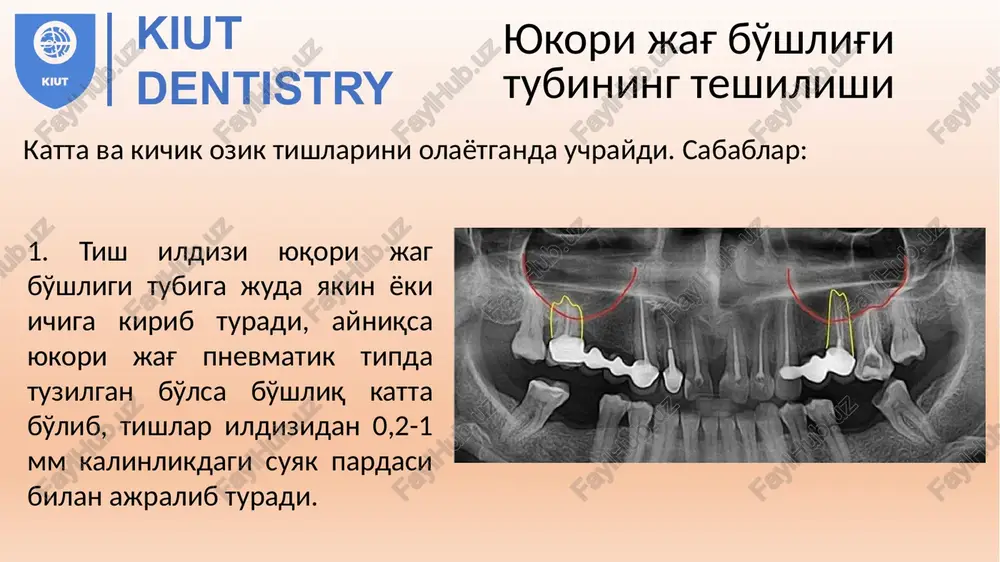 odontogensinuzitning asoratlari - Page 4