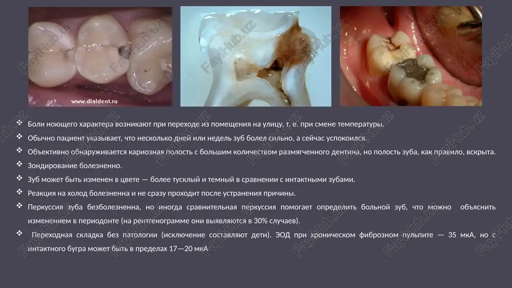 pi snijena snachala do 40-60 mka, zatem do 60-80 mka. xronicheskiy gangrenozniy pulpit chashe drugix form vospaleniya soprovojdaetsya patologicheskimi izmeneniyami apikalnogo periodonta na rentgenogramme mojno viyavit rasshirenie periodontalnoy sheli i deformatsiyu ee. surunkali fibroz pulpit quyidagi kasalliklar bilan qiyosiy tashxislanadi: chuqur karies, o'tkir o'choqli pulpit surunkali gangrenoz pulpit bilan. 11 surunkali fibroz pulpit va chuqur kariesning qiyosiy tashxisi: umumiy belgilari: chuqur kariz kovakning mavjudligi; barcha ta'sirlovchilardan vujudga keluvchi og'riqqa. 12 farqlari: surunkali fibroz pulpitda stimulga nisbatan og'riqli reaktsiya sabab bartaraf etilgandan so'ng darhol yo'qolmaydi va chuqur kariesda esa darhol og'riq to'xtaydi; surunkali fibroz pulpitda pulpa kamerasi bilan aloqa mavjud bo'lib, uning zondlanishi keskin og'riqli va chuqur kariesda karies bo'shlig'ining pastki qismi zich, zondlash pastki va dentin-emal chegarada og'riqli bir xil bo'ladi; anamnezdan shuni aniqlash mumkinki, surunkali fibroz pulpitda bilan tish oldinroq og'riydi va chuqur karies bilan o'z-o'zidan yoki simillovchi og'riqlar bo'lmagan; surunkali fibroz pulpitda eod — 35—40 mkagacha, chuqur kariesda …