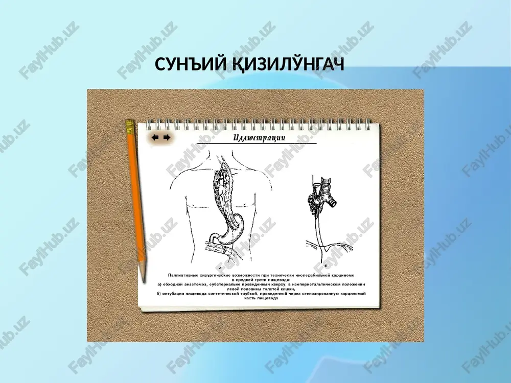 bryusova sxemasi patologiyada organlarning topografik anatomiyasi mak-burney nuqtasi d. n. lubotskiyning sxemasi jarrohlikda mexanizatsiya jarrohlikda mexanizatsiya sun'iy organlarni yaratish bolalar xirurgiyasi. bolalarda tug'ma nuqsonlar tug'ma yurak nuqsonlari, qon va limfa tomirlari. bosh, bo'yin, umurtqa pog'onasi, miya va orqa miya rivojlanish nuksonlari. ko'krak devori va ko'krak bo'shlig'i organlarining rivojlanish nuksonlari. qorin devori va qorin bo'shlig'i organlarining rivojlanish nuksonlari. siydik-tanosil tizimining rivojlanish nuksonlari bolalar amputatsiyasi jarrohligi bolalar jarrohligi behushlik va immobilizatsiyani tanlash bolalar jarrohligida ham mahalliy, ham umumiy anesteziya qo'llaniladi. ammo, aksariyat hollarda siz umumiy anesteziyadan foydalanishingiz kerak, chunki operatsiya paytida bolalarda og'riqni yo'qotish etarli emas, lekin siz ongni ham o'chirishingiz kerak. agar bolaning operatsiyasi lokal anestiziya ostida boshlangan bo'lsa, anesteziyaga o'tish zarur bo'lishi mumkinligiga doimo tayyor bo'lish kerak. bolalar jarrohligida ingalatsion va noingalatsion anesteziya qo'llaniladi. anesteziyaning asosiy vazifasi bemorni operatsion shikastlanishga javoban yuzaga keladigan og'ir patologik reaktsiyalardan himoya qilish va jarrohlik uchun maqbul sharoitlarni ta'minlashdir. bu vazifani faqat anesteziyaning ayrim tarkibiy …