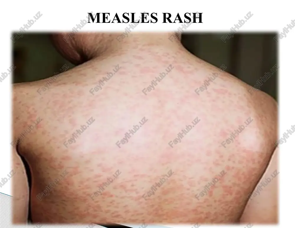 measles - Page 4