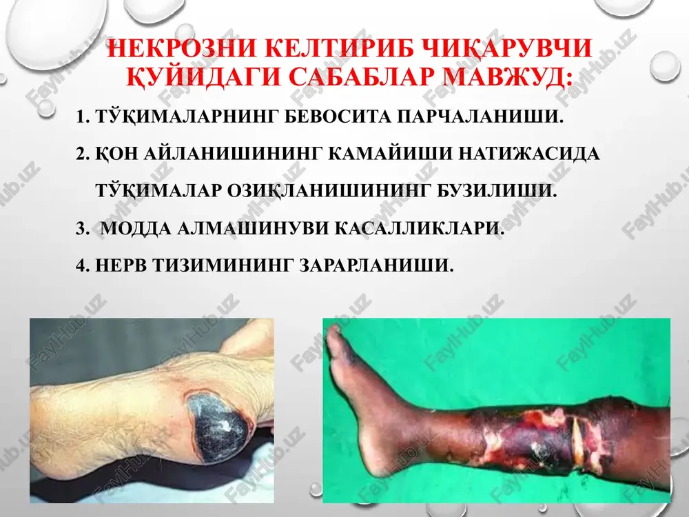 maydi. odatda bemorlarning umumiy ahvoli qoniqarli bo'ladi. agarda quruq gangrenaning sababi to'qimalarning maxalliy shikastlanishi (lat eyish, sovuq urishi) bo'lsa, oyoq qo'llarning boshqa joylarida qon aylanishining buzilishi, teri rangi va haroratining o'zgarishi kuzatilmaydi. davolash: 1. oyoq qo'llarni immobilizatsiya qilish. 2. quruq bog'lamlar qo'yish. 3. fizioterapevtik muolajalar (uvch, kvarts bilan nurlatish). 4. nekrektomiya. 5. oyoq qo'llarni amputatsiya qilish. ho'l gangrena: ho'l gangrena asosan to'la (semiz) bemorlarda, qon aylanishining o'tkir buzilishi (yirik qon tomirlarining shikastlanishi, emboliya) natijasida uchraydi. ko'pincha jarayonga yiringli yoki chirituvchi infektsiya ko'shiladi. ho'l gangrenaning rivojlanishiga to'qimalar shishidan (yurak etishmovchiligida, buyrak kasalliklarida va boshqalarda) tashqari qandli diabet ham sabab bo'ladi. qurishga ulgurmagan o'lik to'qimalar mikroblar uchun yaxshigina oziq muxiti bo'lib xizmat qiladi. to'qimalarning chirib (putrid) parchalanishi kuzatiladi. ko'pincha jarayon anaerob infektsiya (gazli gangrena) bilan birga kechadi, parchalanayotgan to'qimalar kulrang yashil rangli, iflos, sassiq hidli massaga aylanadi. to'qimalar parchalanish maxsulotlarining qonga so'rilishi natijasida organizmning og'ir intoksikatsiyasiga sabab bo'ladi. demarkatsion chiziq hosil bo'lmaydi, …