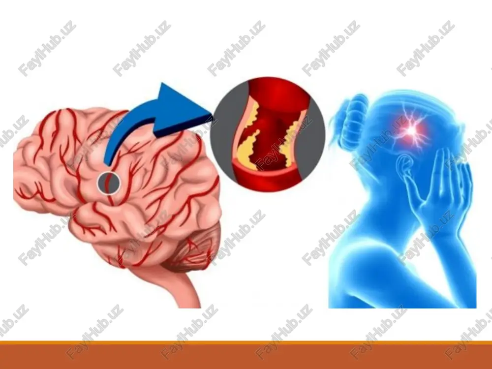 ushdan ketish, likvorda kon bulishi, kurish nervi diski surgichlarida dimlanish, ruxiyat buzilishi, epileptik tutkanoklar xosdir. subaraxnoidal kon kuyilish uchun meningeal belgilarning tez rivojlanishi xarakterli, eruglikdan kurkish, umumiy giperesteziya, ensada ogrik, umurtka pogonasi buylab ogrik, ensa mushaklarining tarangligi oshishi, kerniga, brudzinskiy simptomlari musbat, tana xarorati 39's gacha oshadi. agarda parenxematoz-subaraxnoidal kon kuyilish bulsa uchokli simptomlar shikastlanish uchogiga boglik buladi. i sh e m i k i n s u l t gipertoniya kasalligi bilan aktiv kurashish tufayli gemorragik insultlar ancha kamayib ishemik insultlar soni oshishi sodir buladi. e t i o l o g i ya: - ateroskleroz - gipertoniya kasalligi - revmatizm - arteriitlar (vaskulitlar). - kon kasalligi (leykkemiya, _______________) - tomirlarning travmatik okklyuziyasi, - konning fiziko-ximik xususiyatlarining uzgarishi. - kandli diabet - alkogolizm va x.k.. patogenez. 6o% ishemik insultlar notrombotik genez, kolgan 4o% xollarda insult sababi tromblar buladi. tromb kon tomir devori buzilishi, kon okishining sekinlashishi va konning fizik- …