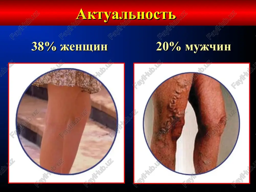 elasticheskaya kompressiya, fleboprotektor, trombotsitarniy dezagregant 6 otkritaya troficheskaya yazva elasticheskaya kompressiya, fleboprotektor, trombotsitarniy dezagregant, ranevie pokritiya farmakologicheskaya aktivnost i klinicheskaya effektivnost osnovnix flebotropnix preparatov preparati tonus ven limfo-drenaj mikro-tsirkulya-tsiya gemore-ologiya kupiro-vanie vos-paleniya troksevazin + + + ? + ginkor fort ++ + + + + glivenol + ? + - + venoruton + + + ? + tsiklo 3 fort + + + ? - endotelon + + ? ? - trental - ? ++ ++ - vobenzim - + + + + flebodia 600 ++ ++ ++ + + geparin o'z ichiga olgan malham va jellar, ginkor-gel, misvengal, indovazin, venoruton va troksevazinning malham shakllari, venitan, fastum-gel, kuriozin, kortikosteroid malhamlari. varikoz tomirlarini kompleks davolashga qo'shimcha davolashning har qanday bosqichida buyuriladi topicheskie sredstva * 1. elastik siqish tibbiy elastik bandajlar tibbiy kompressli paypoq 2. intervalent pnevmokompressiya kompressionnoe lechenie * mushaklararo venoz pleksuslar, yuzaki va teshuvchi venalarning siqilishi pastki ekstremitalarning patologik venoz …