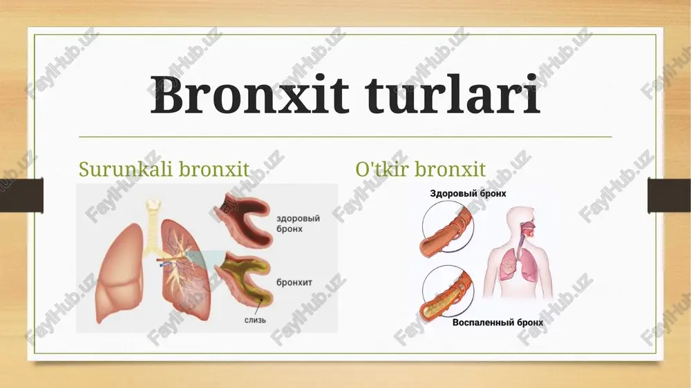 motiouche quilishi bilan xarakterlanadi (16-rasm). 16-rasm tasnifi. quyida surunkali bronxitning oddiy va amaliyotda foydalanish uchun qulay bo'lgan tasnifi keltirilgan. 1. surunkali bronxitning shakllari: * oddiy (obstruktiv bo' imagan); * obstruktiv. 2. klinik-laborator va morfologiyasi bo yicha: * kataral; * shilliq-yiringli yoki yiringli. 3. kasallik bosqichi: * qo'zish; * klinik remissiya. tasnifi. 4. og'irlik darajasi: * yengil - bir soniyada jadal nafas chiqarish hajmi 70% dan ko'p; * o'rta - bir soniyada jadal nafas chiqarish hajmi 50 dan 69% gacha; * og'ir - bir soniyada jadal nafas chiqarish hajmi me yorga nisbatan 50% dan past. 5. surunkali bronxitning asoratlari: * o pka emfizemasi; * nafas yetishmovchiligi (surunkali, o'tkir); * bronxoektazlar; * o'pkaning ikkilamchi arterial gipertenziyasi; * o'pkali kechishi,bronxlardagi patologik jarayon va klinik ko'rinishining xususiyatlariga ko'ra yugorida qayd etilganidek, surunkali bronxitning ikkita asosiy shakli farqlanadi va ular quyidagicha namoyon bo'ladi : 1. surunkali oddiy (obstruktiv bolmagan) bronxit – unga proksimal (yirik va …