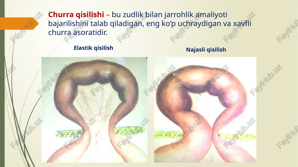 nishi shart. shundan so'ng olib keluvchi va olib ketuvchi qovuzloqlarga ichaklararo anastomoz quyiladi. 13 qisilishdan o‘tgan vaqtga nisbatan jarrohlik amaliyotidan keyingi o‘lim darajasi soat qisilgan churralarda shoshilinch operatsiya zarur, qanchalik operatsiya kech bo'lsa, shuncha bajariladigan operatsiya natijasi salbiy tomonga o'zgaradi. qisilgan churra xaltasidagi infektsiya qorin bo'shlig'iga tarqaladi, peritonit keltirib chiqaradi, bemor parenximatoz a'zolarining etishmovchiligi qo'shiladi. 14 qisilgan churrani kuch bilan to’g’rilash mumkin emas!!! qisilgan a'zoni holatini bilmaysiz qisib turgan halqa bilan to‘g‘rilab yuborishingiz mumkin qisilgan a'zolarga jarohat yetkazishingiz mumkin ! qisilgan churrani kuch bilan to'g'rilash mumkin emas, chunki qisilgan a'zo holatini bilish imkoni yo'q, ikkinchidan qisib turgan xalqa bilan to'g'rilab yuborish mumkin,…. 15 asoratlar perforatsiya churra darvozasining uzilishi …. uchinchidan qisilgan a'zoga jarohat etkazish mumkin. 16 jarohatlanish (travmatizasiya) yoki aseptik yallig‘lanish hisobiga churra qopi va churra tarkibidagi a'zo orasida chandiqlarning hosil bo‘lishi bilan bo‘lgan asoratdir. to‘g‘rilanmaslik churra to'g'rilanmasligi – bu travmatizatsiya yoki aseptik yallig'lanish hisobiga churra xaltasi va churra tarkibidagi …