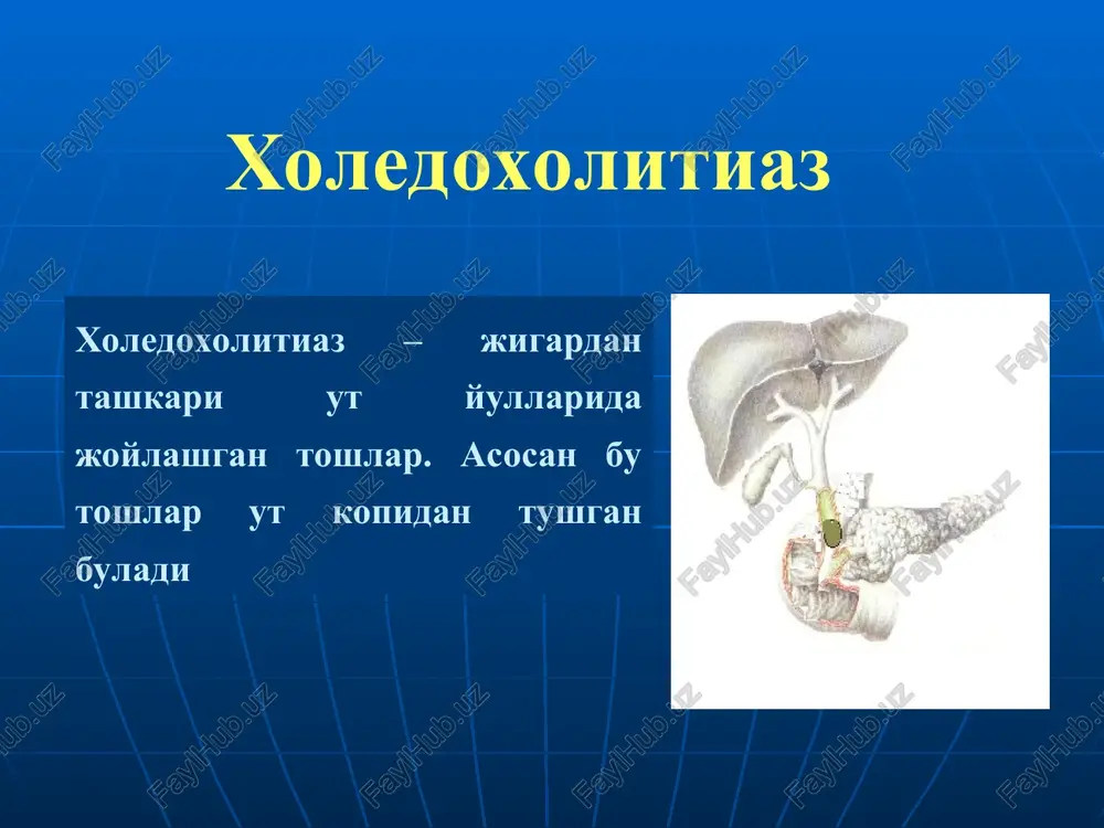ensiv davo sharoitida davolash zarur limfo- yoki gemosorbtsiya, me'da-ichak traktini tozalash (oshqozon yuvish, sifonli ho'kna) kortikosteroidlar katta dozada tavsiya qilish (prednizolon, gidrokortizon) proteolitik fermentlarni tavsiya etish (trasilol, kontrikal, gordoks) o't passajini tiklaydigan jarrohlik amaliyotlar endoskopik papilosfinkterotomiya dormiya zondi orqali o't toshlarini olib tashlash yumshoq qisqich orqali o't toshlarini olib tashlash fogarti zondi yordamida orqali o't toshlarini olib tashlash xoledox terminal qismini ikkilamchi strikturasida dilatatsiya qilish ikkitali lateksli balon yordamida toshlarni olib tashlash mexanik litotripsiya va aspiratsion usul toshni olish uchun “halqali-ilmoq”ni qo'llash endoskopik retrograd endobiliar amaliyotlarga ko'rsatma uttda xoledox diametri 8 mm dan ortiq; ms sababi aniqlanganda va patologik o'zgarish o't yo'lida bo'lganda uttda o't yo'llarni ko'rish va farqlash imkoniyati bo'lmaganda, giperbilirubinemiya kuzatilsa xoledoxolitiaz stenozlovchi papillit xoledox terminal qismini va katta duodenal so'rg'ichni 1,5 sm gacha bo'lgan stenozi i va ii darajali jigar etishmovchiligi bilan kuzatiladigan mexanik sariqlik qarshi ko'rsatmalar yuik – yuo'i; mqo'b; o'qte; o'ne endoskopik papillosfinkterotomiya amaliyotiga ko'rsatma …
