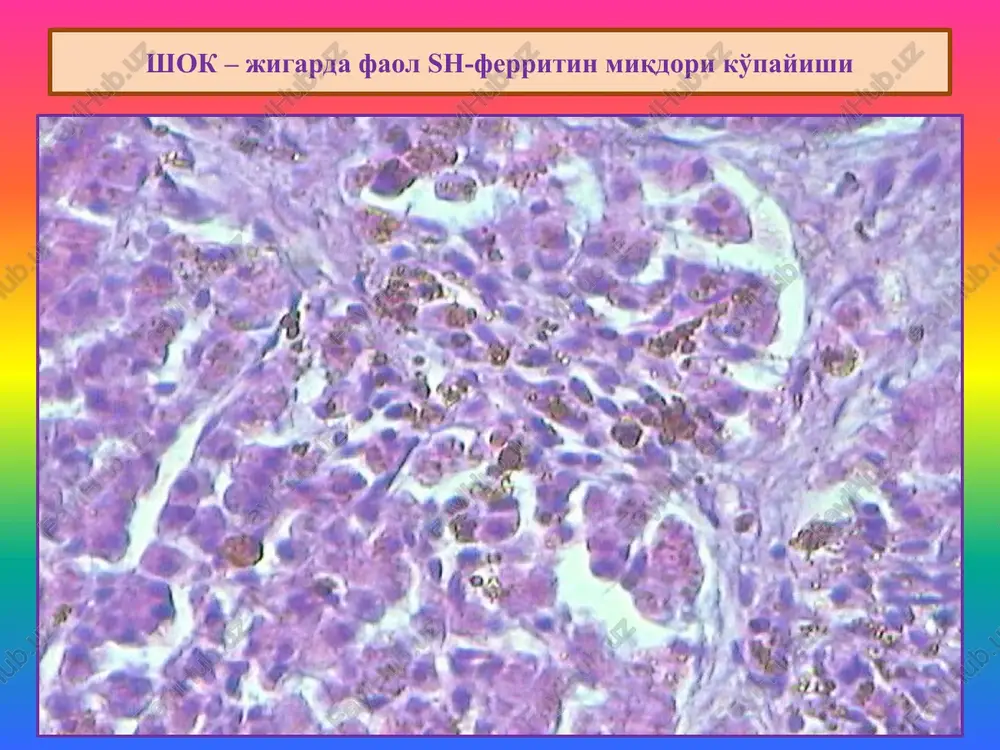 t of a jaundice are various, that allows to allocate three its principal views: 1) supperhepatic (hemolitic), 2) hepatic (parenchimatous), 3) upperhepatic (mechanical). 1.gemolitik sariqlik – mandarin rangi. 2.parenximatoz sariqlik – limon rangi. 3.mexanik sariqlik – appelsin rangi. aralash distrofiyalar patologik gemoglobinogen pigmentlar 1. gematoidin. 2. gematin (bezgak gematini, nsili gematin, formalinli gematin). 3. porfirin. gematoidinning paydo bo'lishi va joylanishi paydo bo'lishi: 1.hujayra ichida paydo bo'ladi. 2.hujayra tashqarisida, nekroz tarkibida to'planadi. joylanish joyi: 1.gematomalarda. 2. chandiqlanayotgan infarkt o'chog'ida. aralash distrofiyalar in a hematoma the pigment hematoidin is formed also. if to investigate a hematoma prescription more than 7-10 days on periphery and in live cages it is possible to find out a brown pigment hemosiderin, and in the centre of dead fabrics - crystals hematoidin. bezgak gematini paydo bo'lish mexanizmi 1.bezgak plazmodiysining eritrotsitga kirishi. 2.gemoglobindan globinning ajralishi. 3.gemning oksidlanishi. 4.plazmodiyning ichida qora rangli pigmentning paydo bo'lishi. aralash distrofiyalar xlorid kislotali …