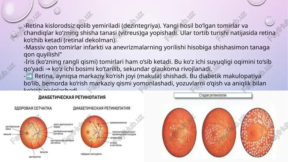 iya , sby davolash -operatsiya. buyraklar koʻchirilib oʻtkazilganda ham 5 yilda yana qaytalanadi -apf ingibitorlari beriladi. asosan abni pasaytirishga asoslangan. anfiotenzon i ni ii ga aylantirib beradi. angiotenzin ii kam aldosteron ham kamayadi. qon tomir toʻraymaydi. qon bosimi pasayadi. diabetik nefropatiyada arterial gipertenziya tez-tez uchraydi. -kalsiy kanal blokatorlari (amlodipin, nifedipin, verapamil, diltiazem) tomirlarni kengaytiradi → bosimni pasaytiradi. diabetik neyropatiya diabetik neyropatiya har ikki turdagi diabetda ham keng tarqalgan. uningrivojlanish tezligi diabet yoshi va davomiyligi bilan ortadi. tasnifi markaziy asab sistemasi buzilishi -ensefalopatiya -mielopatiya periferik asab tizimi shikastlanishlari -diabetic polineyropatiya -sensor shakl -motor shakl -sensomotor shakl -diabetik mononeyropatiya avtonom neyropatiya -kardiovaskulyar shakl -gastrointestinal shakl -sporadic shakl -asimptomatik gipoglikemiya patogenezi patogenezining bir nechta nazariyalari mavjud 1.poliol nazariyasi qonda doimiy giperglikemiyanerv ichida insulinga bog’liq bo’lmagan giperglikemiyanervda ortiqcha glyukoza sorbitolga aylanadimonoinozitol saqlanishi pasayadina, k,atf aza faollashib energiya hosil bo’ladi nerv uchun. ortiqcha sorbitol aksonda osmotic shish endonevral mikroangiopatiyalar doimiy giperglikemiya nerv kapillyarlarining devori qalinlashishi …
