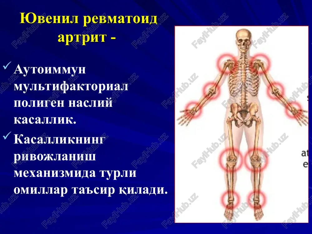 variantida ko'pincha subfebril, poliartritli tizimli variantida – subfebril va febril, oligoartritli tizimli variantda– febril, gektik. ko'pincha ertalab kuzatiladi. oligoartritli tizimli variantda kunduzi va kechqurun kuzatilishi mumkin * tana xarorati ko'tarilganda bemor ko'p terlashi, artralgiyaning kuchayishi, toshmalar toshishi, intoksikatsiyaning kuchayishi kuzatilishi mumkin. tana xaroratining pasayishida ko'pincha juda ko'p terlash kuzatiladi. tana xaroratining ko'tarilishi oligoartritli tizimli variantda bir necha xafta va oylar davom etishi mumkin. * toshmalar yura ning tizimli variantida kuzatiladi papulez, chiziqli, ko'p xollarda– petexial qichishmaydi. bo'g'imlar oldida, yuzda, ko'krak qafasida, qorinda, tanada, oyoq-qo'llarda joylashadi. tana xarorati ko'tarilganda toshmalar kuchayadi * toshmalar * bo'g'im-vistseral shakli 5 ta belgini o'z ichiga oladi: shiddatli yuqori tana harorati polimorf allergik toshma limfadenopatiya gepatolienal sindrom artralgiyalar/artrit bu shaklning 2 ta asosiy varianti bor: still sindromi vissler-fankoni sindromi bo'g'im-vistseral shakli asosiy klinik simptomlar still sindromi vissler-fankoni sindromi o'tkir boshlanishi + + o'rtacha isitma + - yuqori davomli isitma - + mayda bo'g'imlar zararlanuvchi poliartrit + …