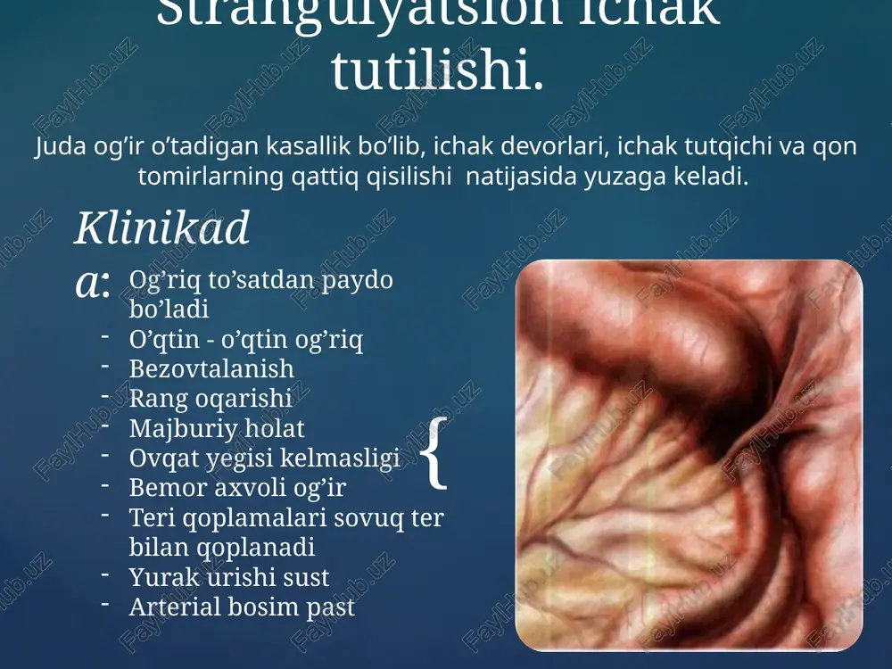 ladigan (“psevdobuyrak” simptomi), qorin bo’shlig’i utt qilinadi. rentgenogramma odatda kam axborotli, kloyberning birlik kosalari invaginatsiyaning kechki bosqichlarida paydo bo’lishi mumkin. invaginatsiyaning klinik alomatlari bo’lganida invaginatsiyaning boshlang’ich muddatlarida (10-12 soat), irrigografiyaning havo yoki suyuqlik bilan bajarilishi kerak. operativ davolash bolaning kech olib kelinishida qo’llaniladi, u invaginat sog’ish uslubi bilan dezinvaginatsiya va laparotomiyadan iborat ichak nekrozi aniqlangan yoki sog’ish imkoni bo’lmagan holatlarda invaginat rezeksiyasini ko’pincha ko’r ichak, silindr ichida amalga oshirishadi. so’ngisining yo’lini baugin qopqoqchadan 1,5-2 sm chetroqda tenia bo’yicha ochib, invaginirlangan ichakni ileosekoanastomoz qo’yish bilan rezetsiyalashadi. davosi dinamik ichak tutilishi. shoshilinch xirurgik moulaja o’tkazilishi shart bo’lgan ichak tutilishi. ichak tutqichidagi mahalliy qon aylanishining buzilishi, periferik va markaziy nerv apparatlari, ichak devorlarini xarakatga keltiruvchi faoliyatning o’zgarishi sababli kelib chiqishi mumkin. ichak devoridagi qon aylanishining buzilishi qorin parda yallig’lanishi, ichak devorining kengayib ketishi, degidrotatsiya va gipoksemiya natijasida kelib chiqadi. 8 – 11 % spastik ichak tutilishi. gijja invaziyasi klinikasi: qorinda kuchli va xurujli …