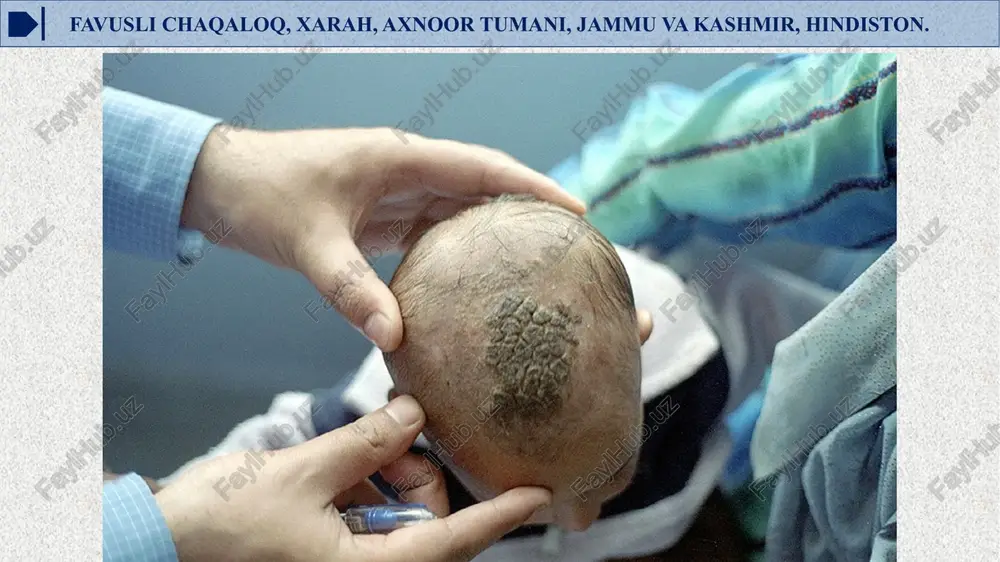 burug'lar keltirib chiqargan kasalliklar maduromycosis chromomycosis patogen zamburug'lar keltirib chiqargan kasalliklar to’rtinchi guruhga chuqur mikozlar (blastomikoz, gistoplazmoz, kriptok okkoz, koksidiodoz) kiradi. bularda ichki a’zo va turli to'qimalar shikastlanadi. blastomycosis patogen zamburug'lar keltirib chiqargan kasalliklar histoplasmosis teri leyshmaniozining qo‘zg‘atuvchisi leyshmaniya (leishmania tropica) jarohatlangan to'qim alarda dumaloq yoki tuxumsimon, noksimon ko'rinishda bo'ladi, xivchinlari yo'q, tanasining uzunligi 2-6 mkm, eni 2-3 mkm. leyshmaniyalar sun’iy ovqatlarda va fflebotomus (iskabtopar chivini) ichagida uzunchoq shaklga aylanib, xivchin hosil qiladi. bularni leptomanad shakllar deyiladi, ular uzunligi 20 m km gacha bo'lishi mumkin teri leyshmaniozining qo‘zg‘atuvchisi leyshmaniya hayot siklida ikki bosqichni o'taydi: xivchinsiz (amastigotlar) - umurtqalilar organizmida makrofaglar va teri, shil liq qavat, taloq, jigar, ko'mik va limfa tugunlarini qamrab olgan hujayralari bo'iadi, xivchinlilar- iskabtopar chivini ichagida joylashadi. hayvonlarga nisbatan patogenligi leyshmaniozning sahro xilida kasallik manbai, qum sichqon, yumronqoziq va qumloq joylarda yashaydigan boshqa kemiruvchilar hisoblanadi. amerika teri leyshiraniozi esa yovvoyi hayvonlar orasida keng tarqalgan. patogen leyshmaniyalarni tajriba …